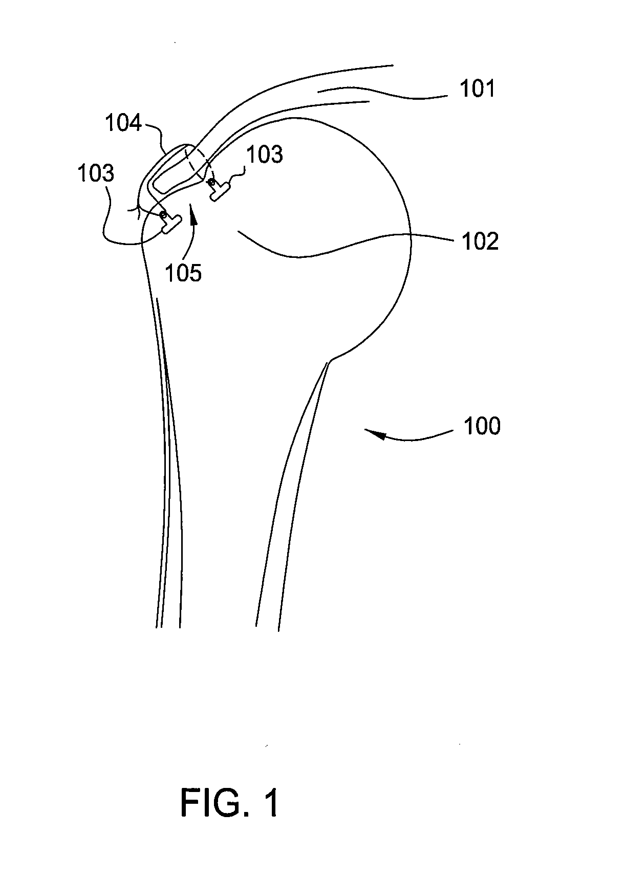 Suture-Retaining Device And Anchor