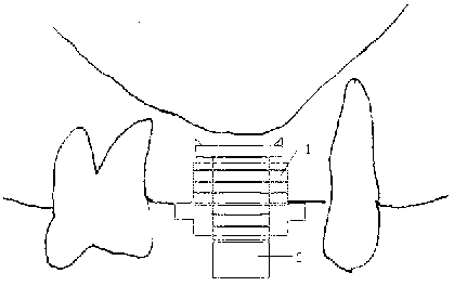 Maxillary sinus floor lifting device and method