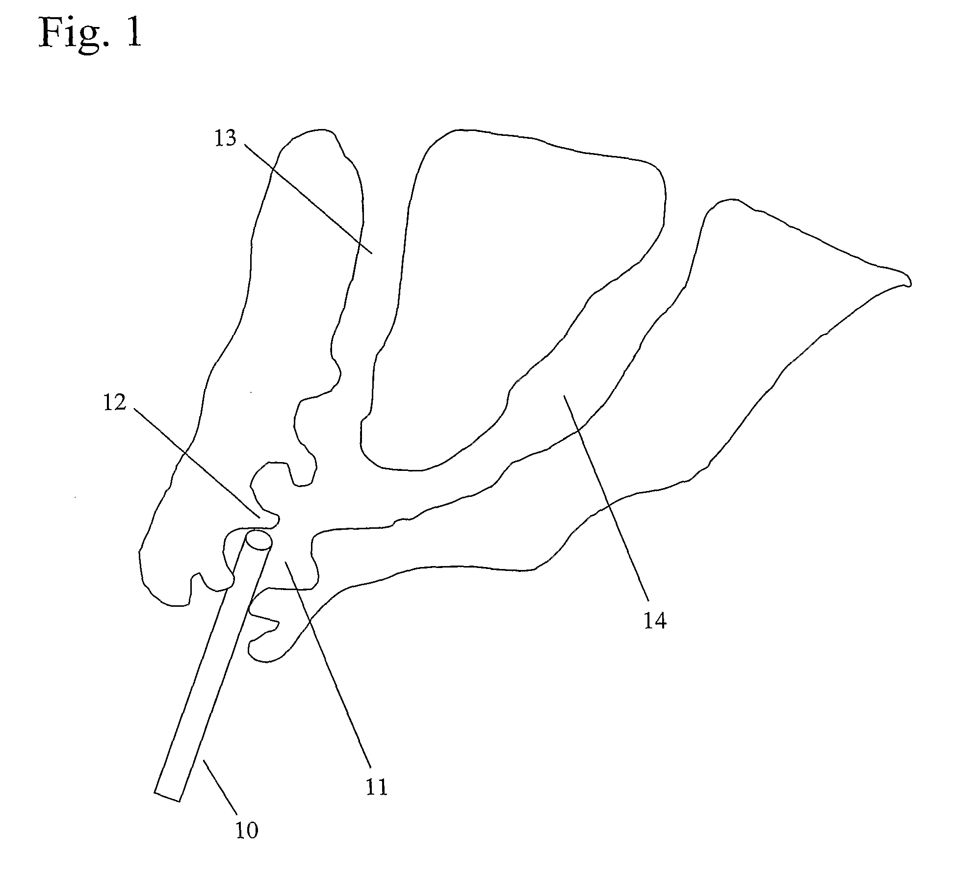 Method and devices for selective endoscopic retrograde cholangiopancreatography