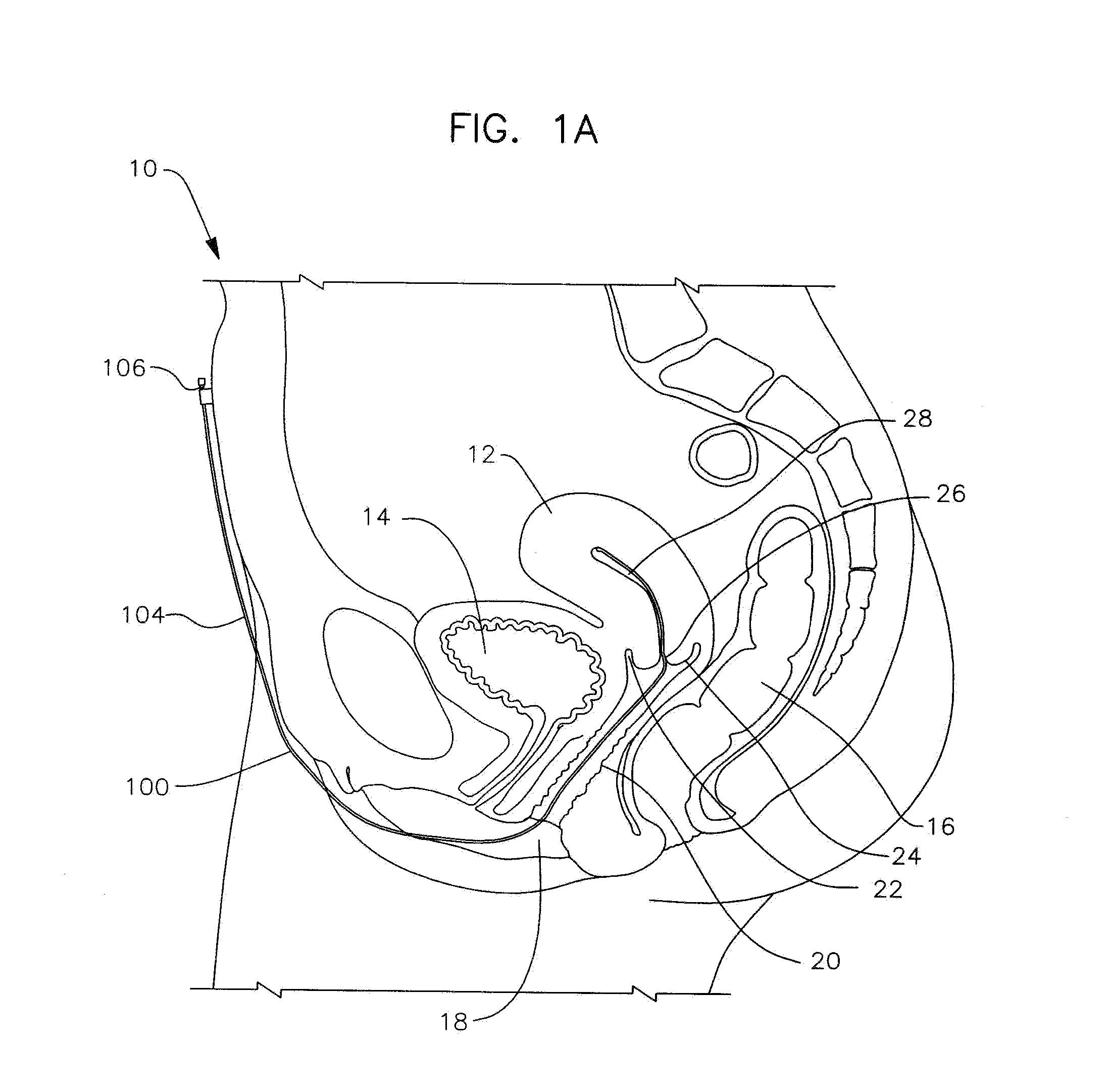 Apparatus and method for the treatment of abnormal uterine bleeding