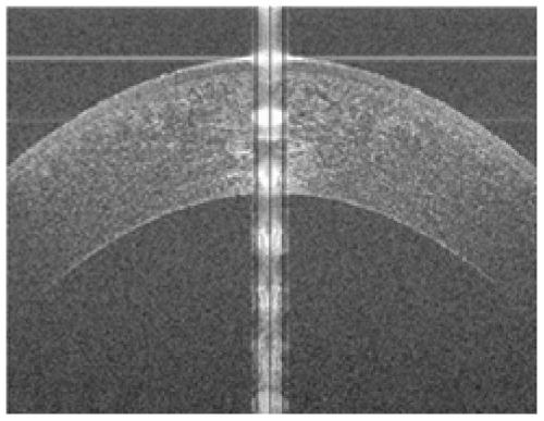 Method and system for segmenting corneal structures from oct corneal images