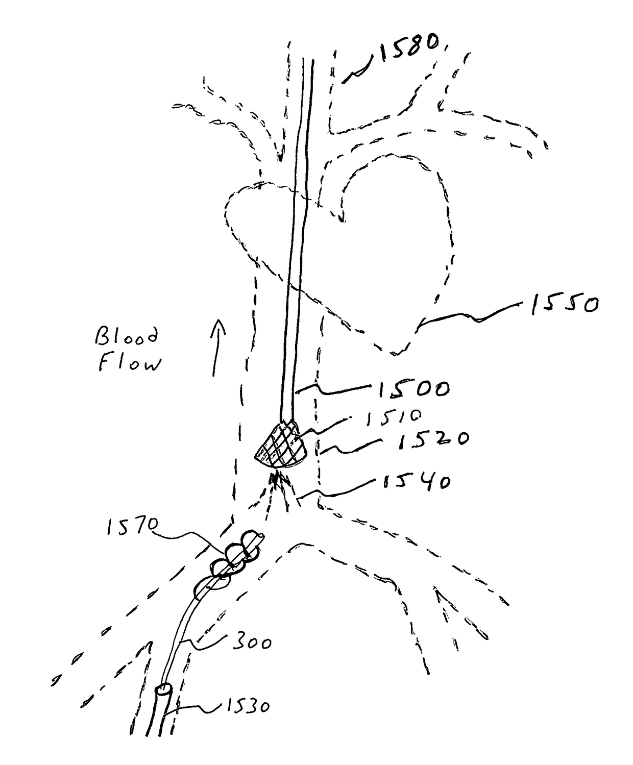 Simultaneous Rotating Separator, Irrigator Microcatheter for Thrombectomy