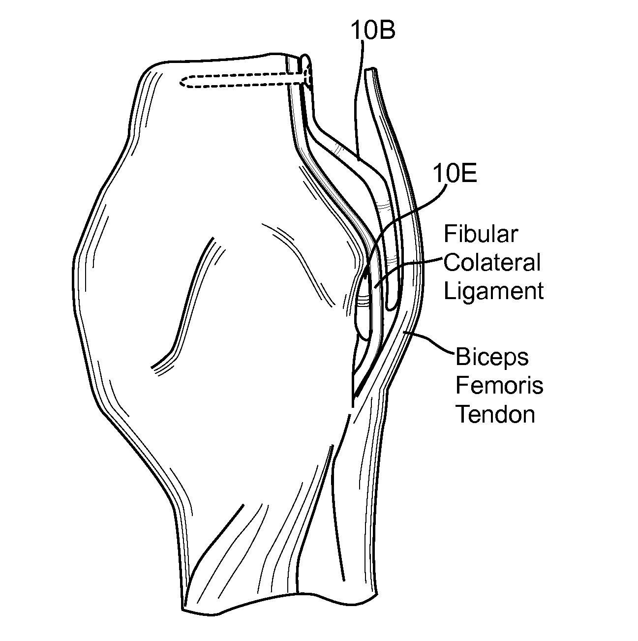 Method and Apparatus for Force Redistribution in Articular Joints