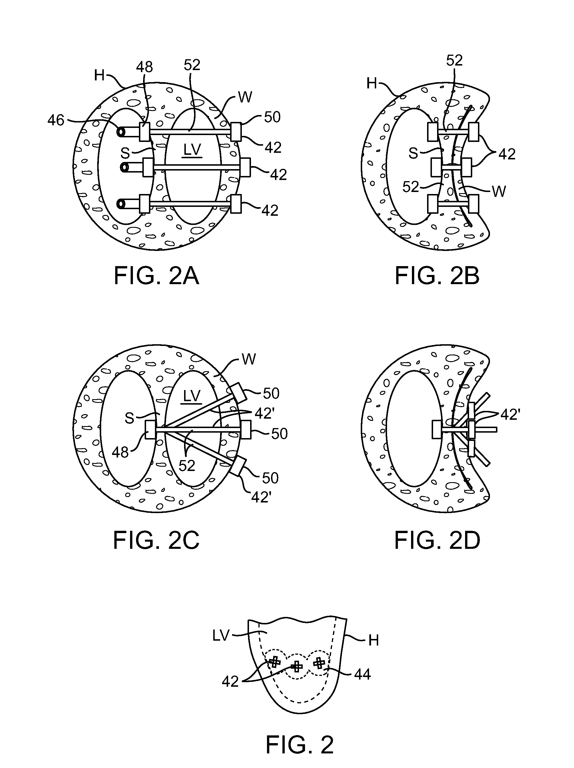Location, time, and/or pressure determining devices, systems, and methods for deployment of lesion-excluding heart implants for treatment of cardiac heart failure and other disease states