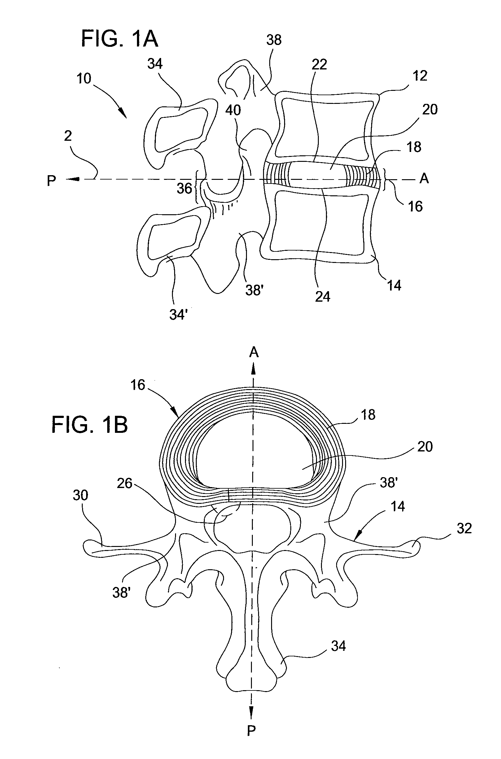 Devices, systems and methods for treating intervertebral discs