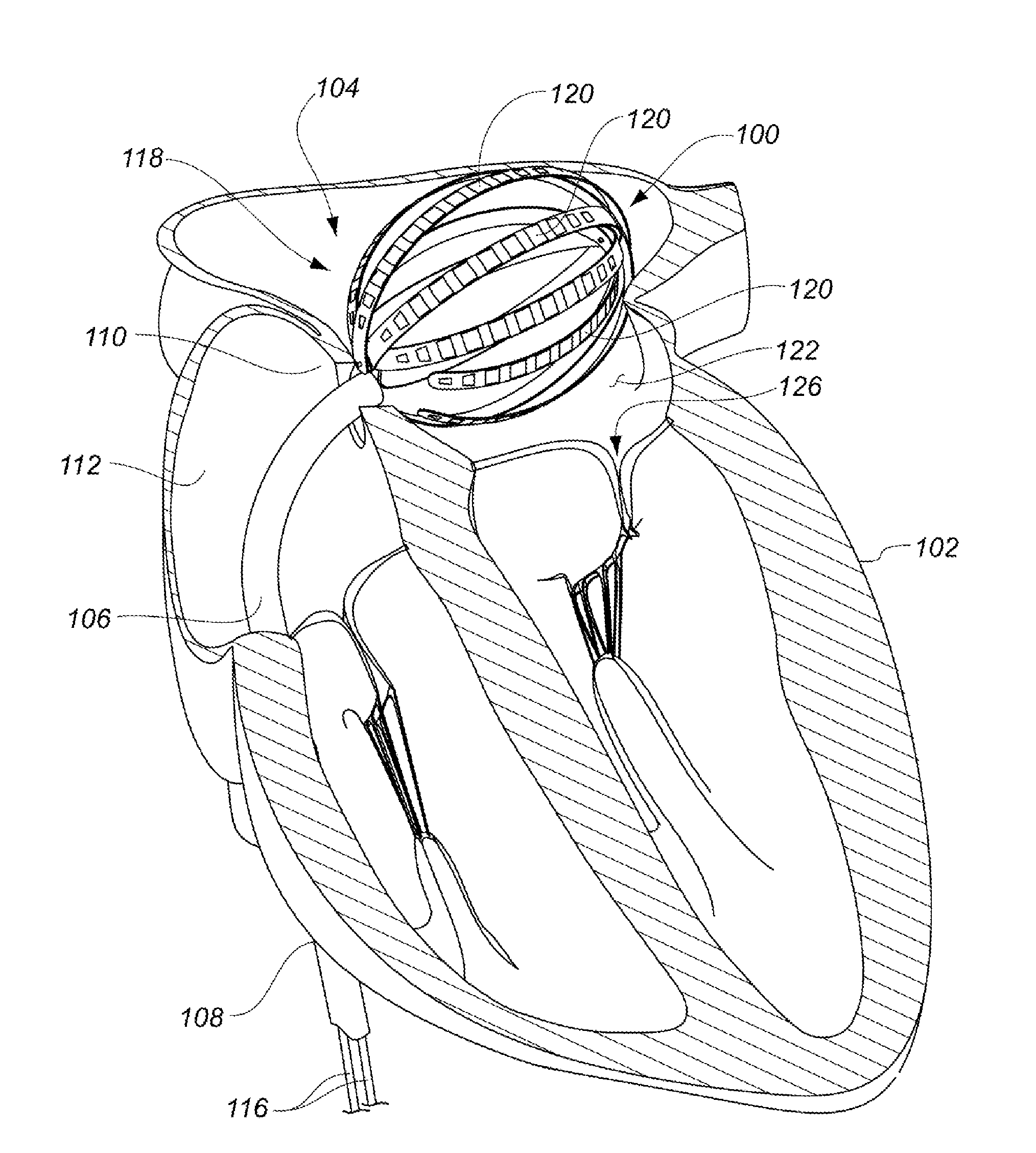 Enhanced medical device for use in bodily cavities, for example an atrium