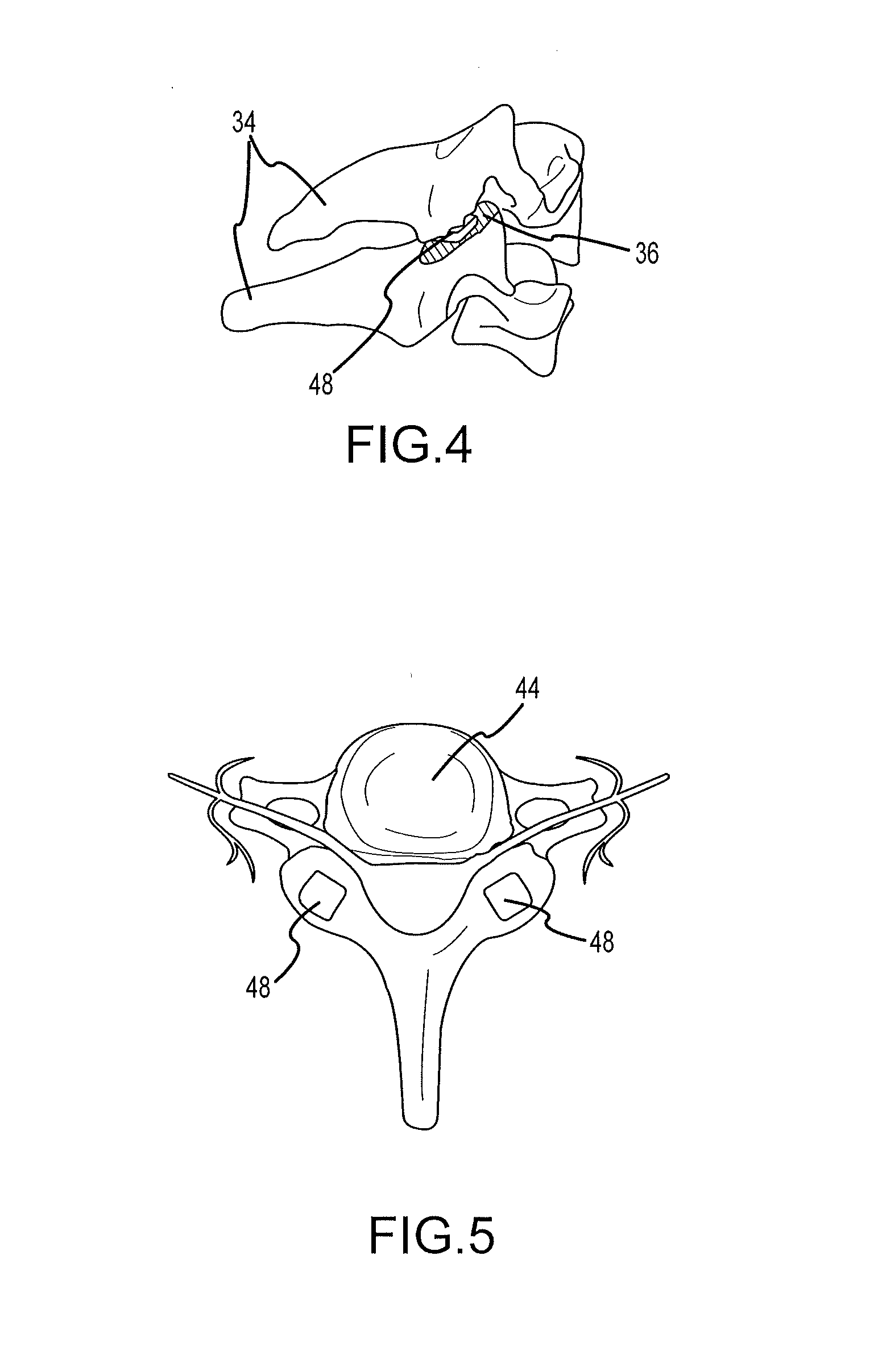 Cervical distraction/implant delivery device