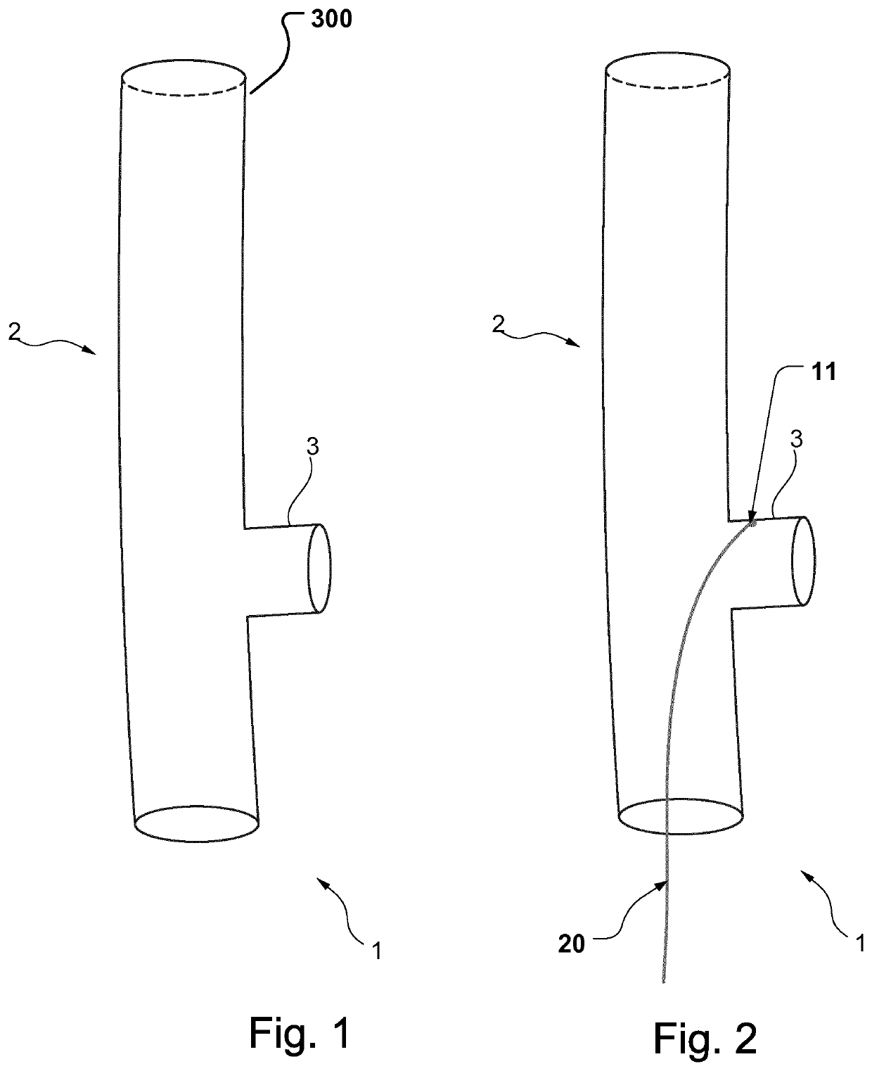 Stent-graft prosthesis, system and method for improved delivery of a stent-graft prosthesis