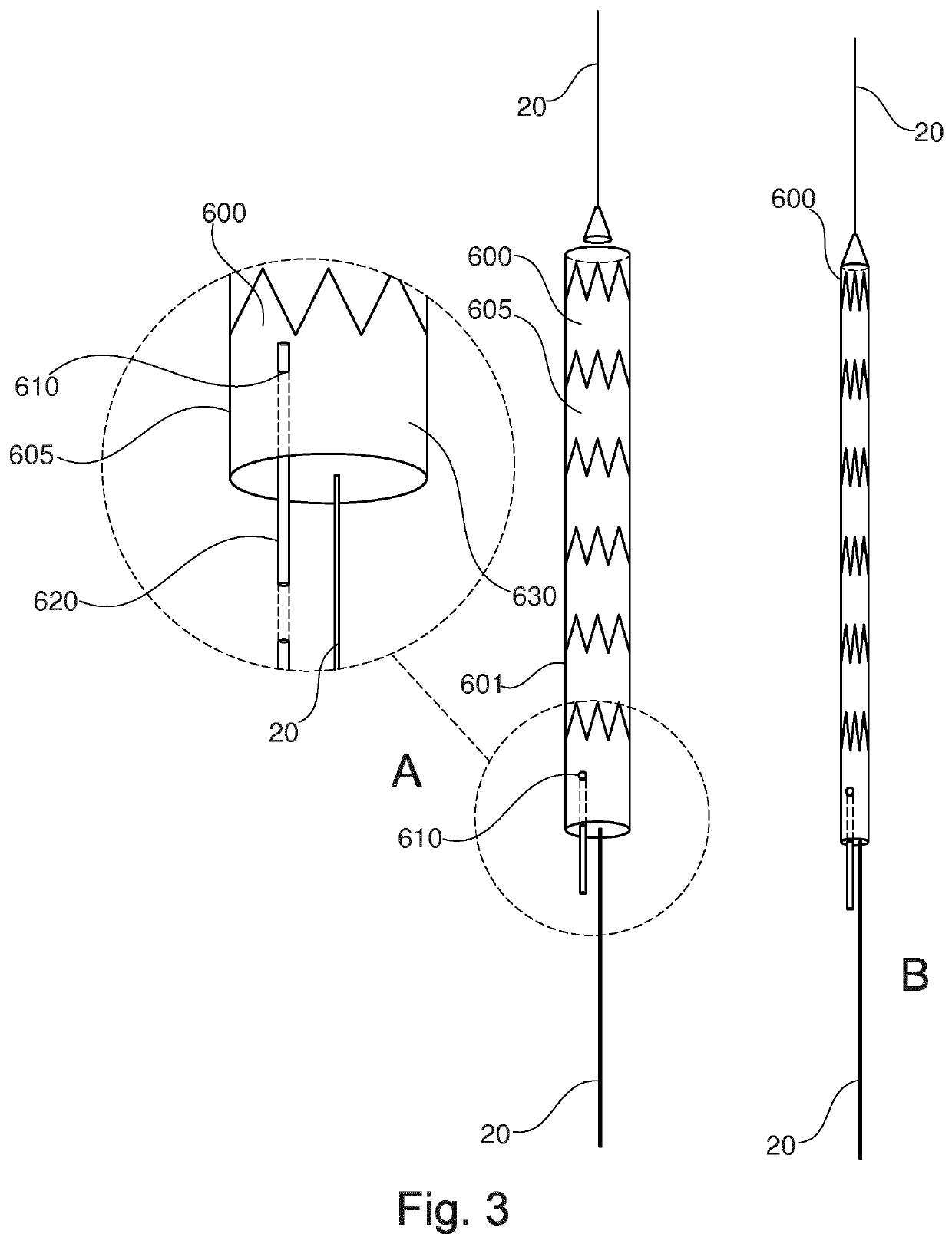 Stent-graft prosthesis, system and method for improved delivery of a stent-graft prosthesis