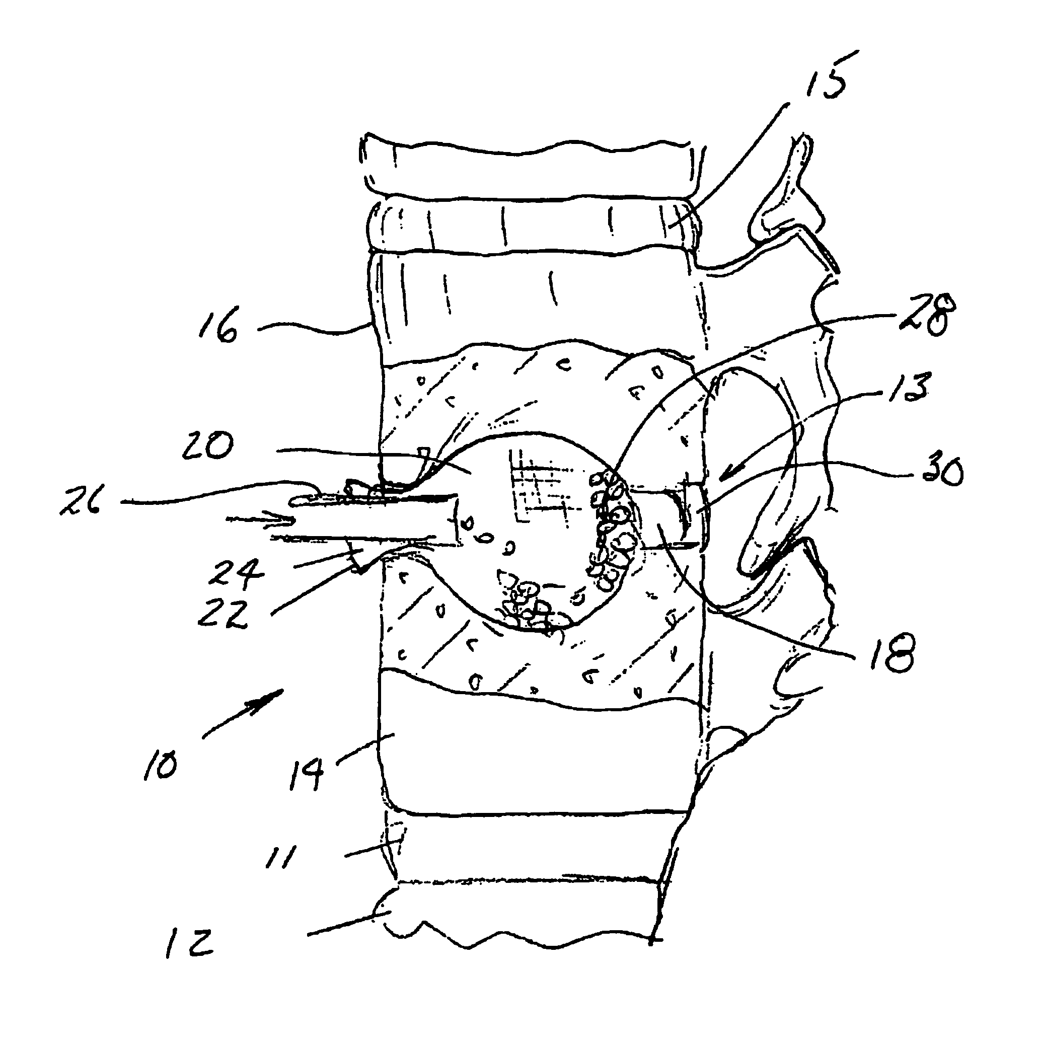 Packable ceramic beads for bone repair