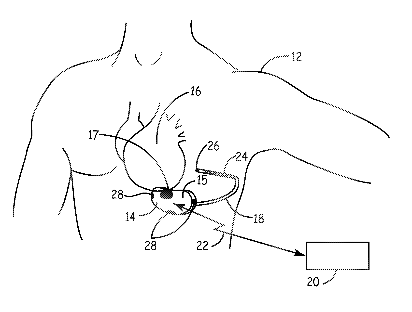 Method and apparatus for verifying a determined cardiac event in a medical device based on detected variation in hemodynamic status