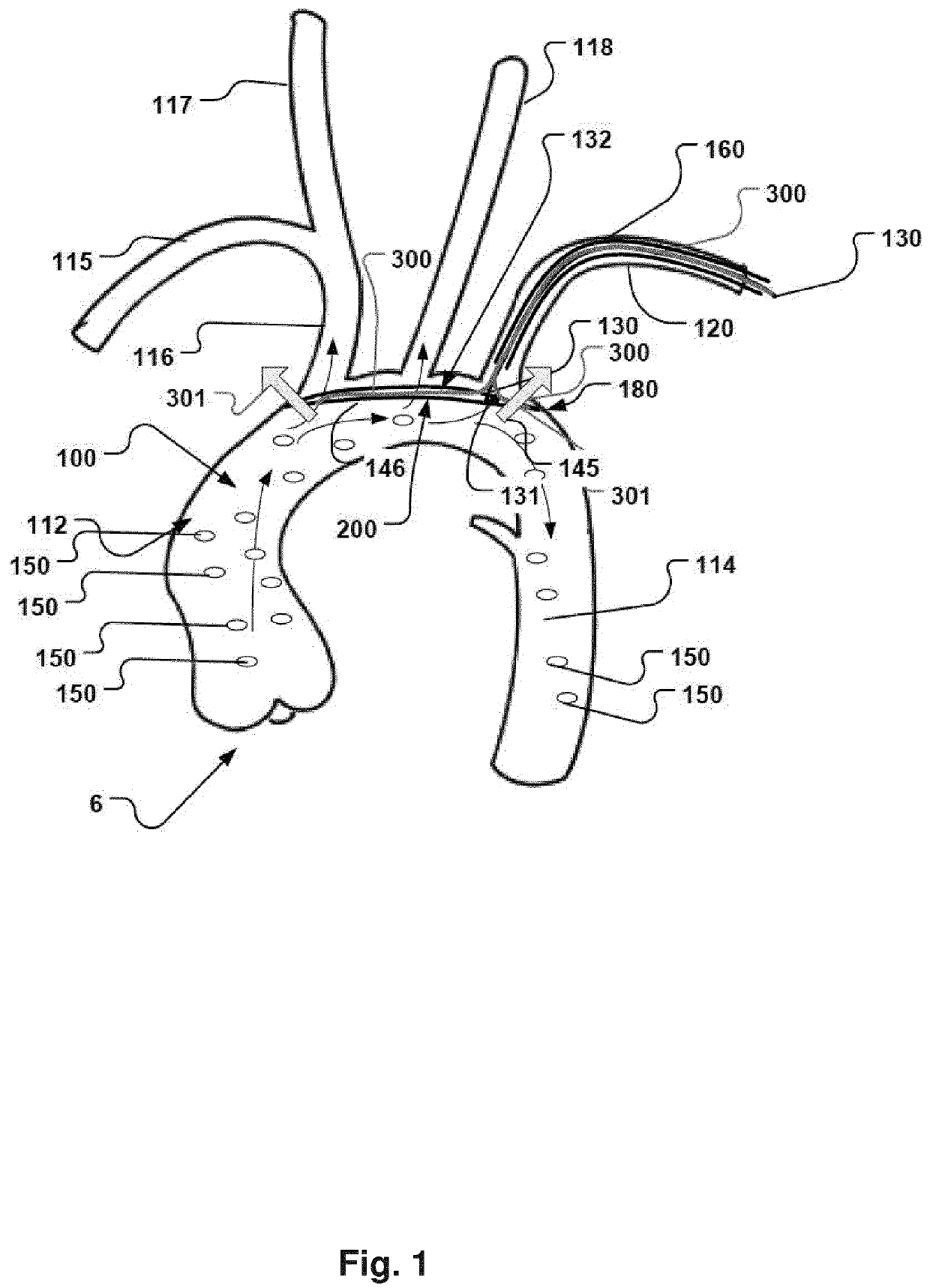 Embolic protection device and method