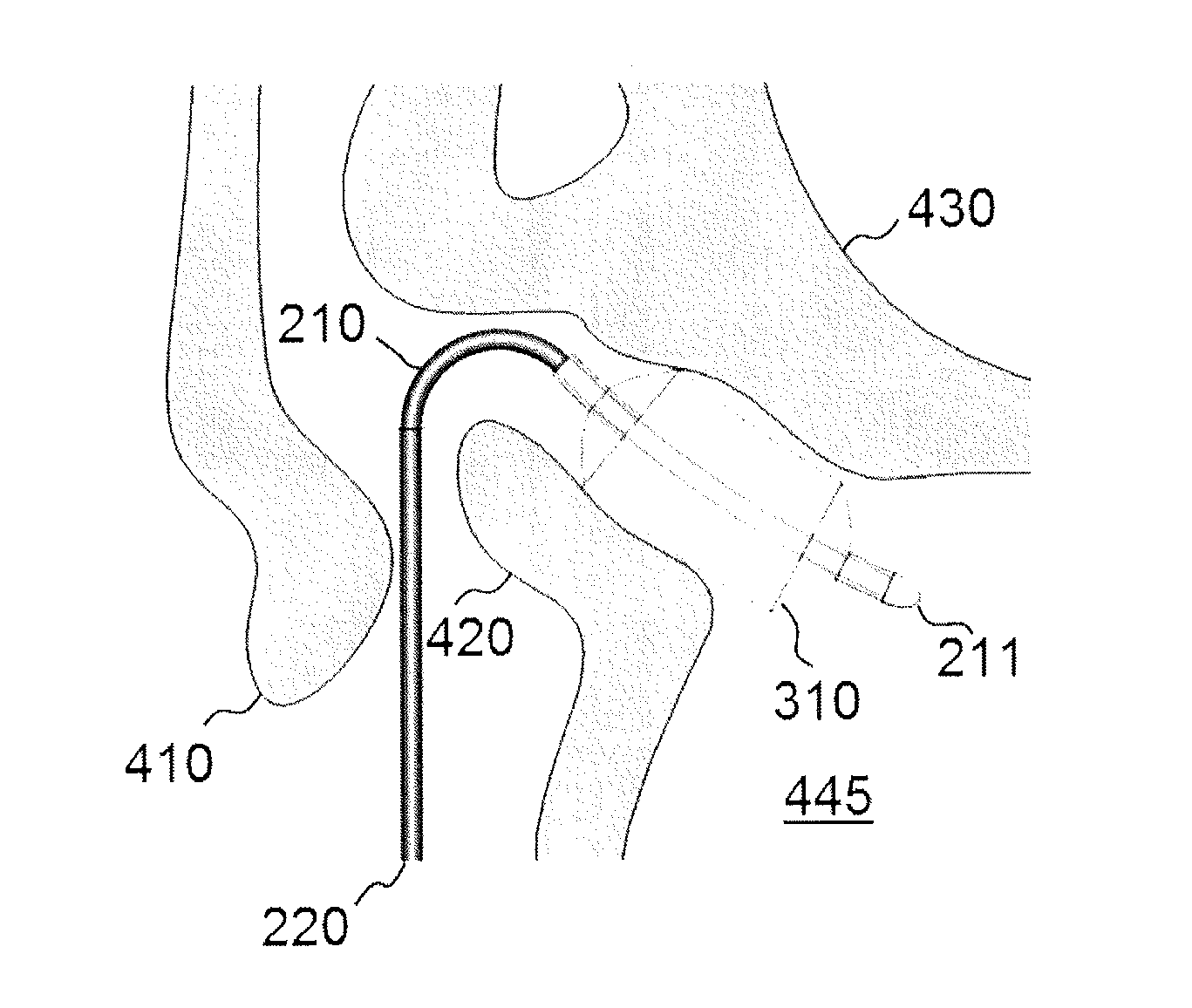Systems, Devices and Methods For Providing Therapy To An Anatomical Structure