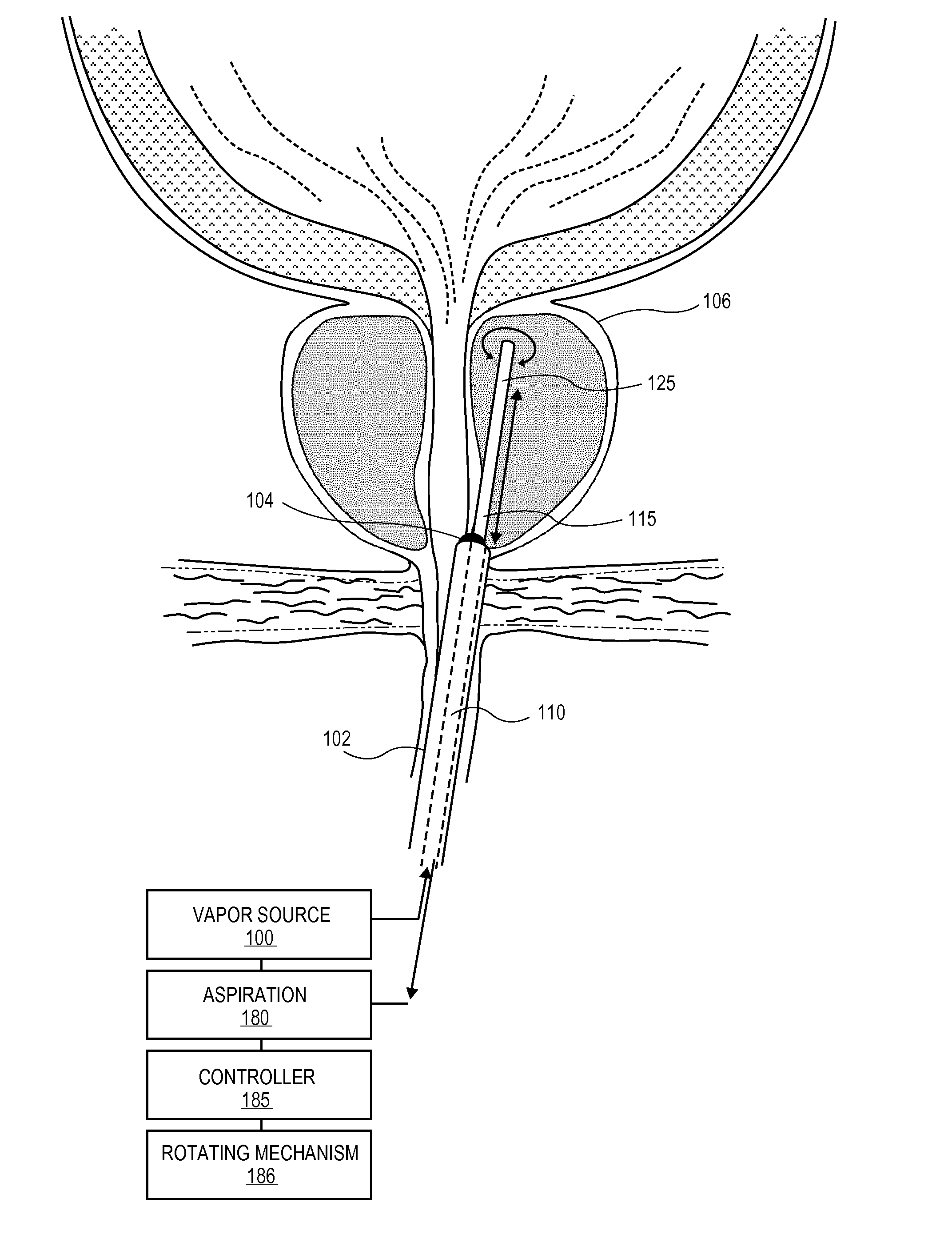 Systems and Methods for Treatment of Prostatic Tissue