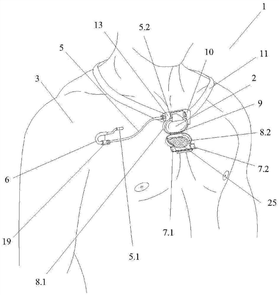 Fastening system for electrical stimulation generator