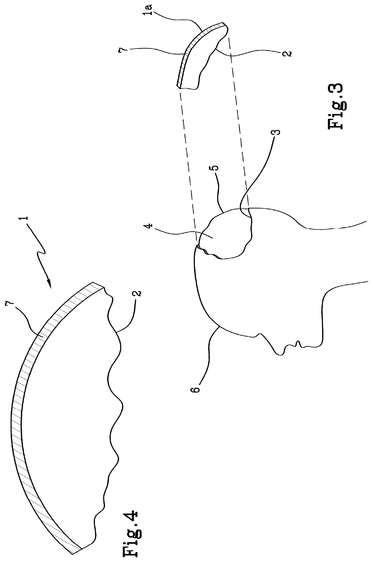 System and method for producing a cranial operculum for a living being