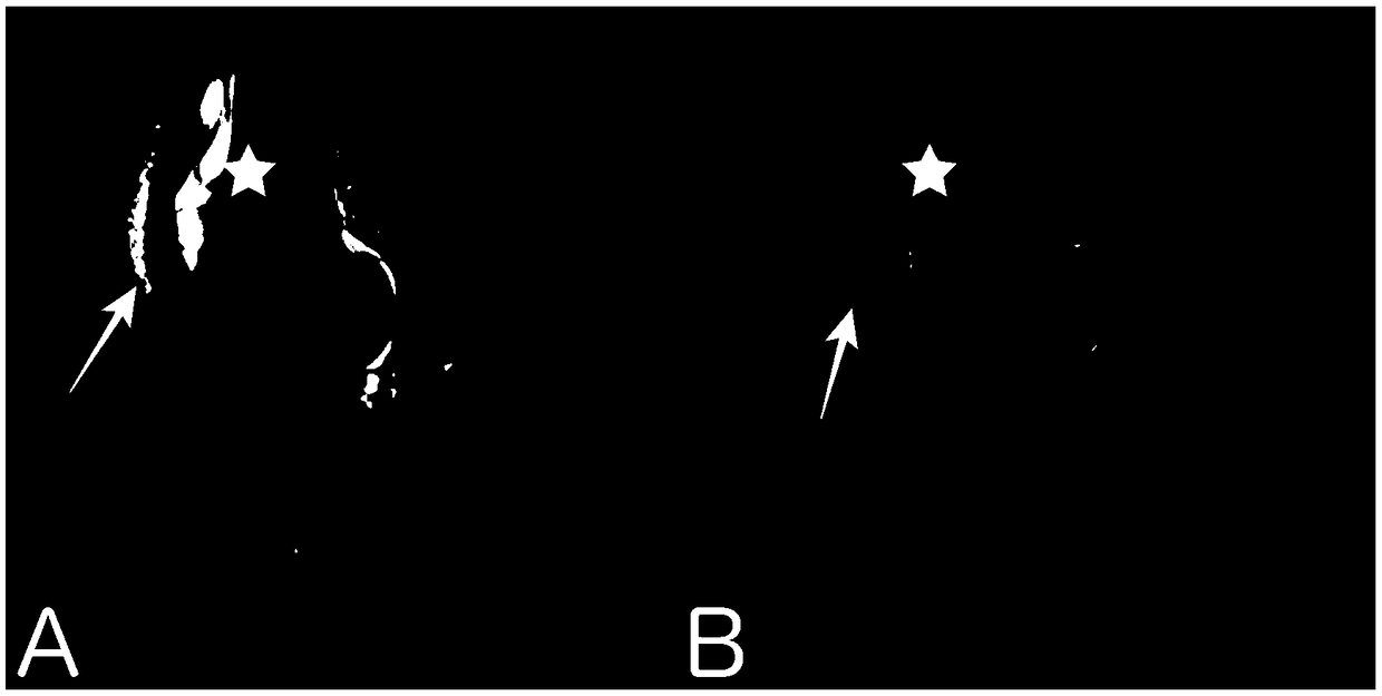 Ointment and device for treating hyperosteogeny