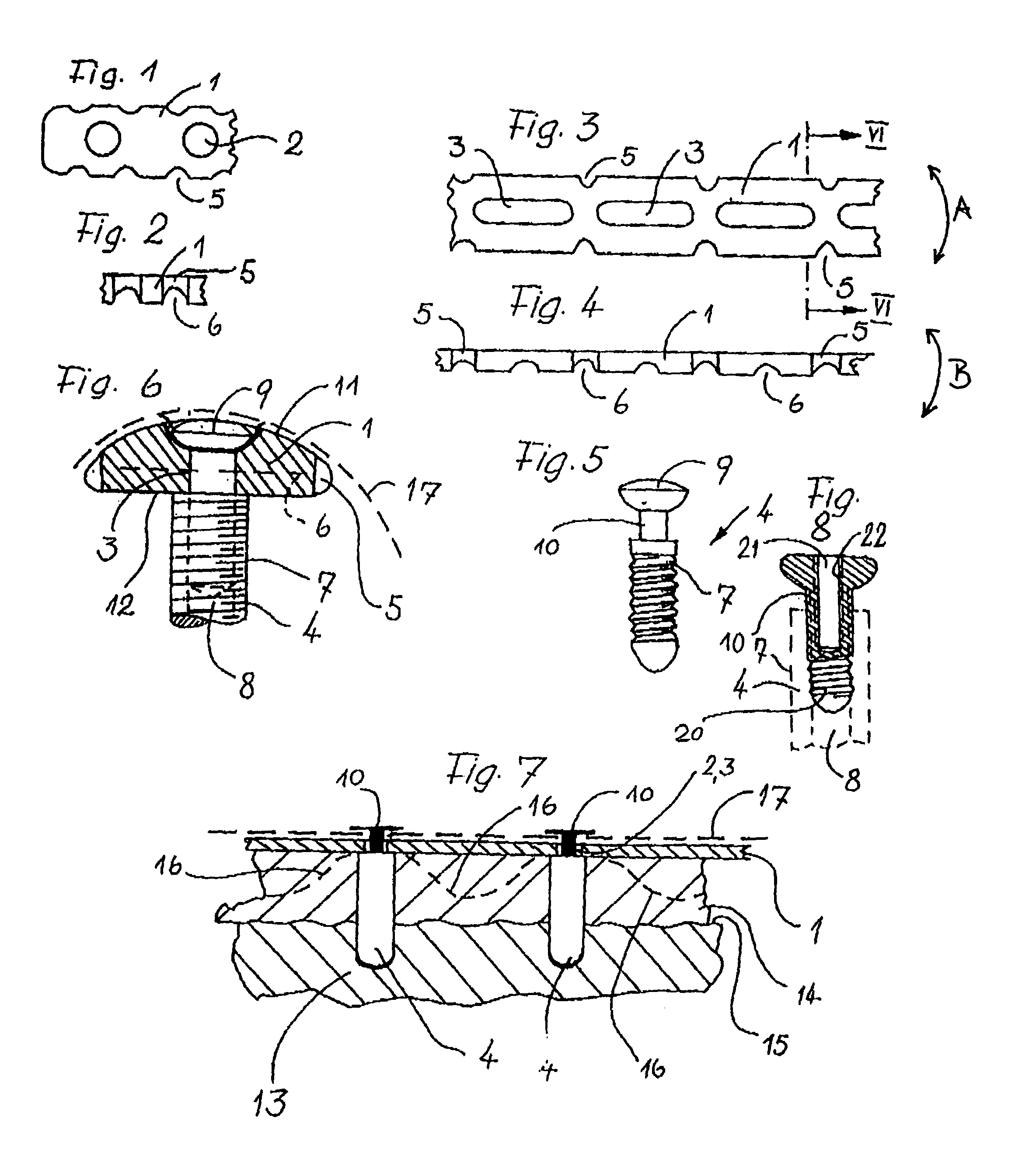 Device for regenerating, repairing, and modeling human and animal bone, especially the jaw area for dental applications