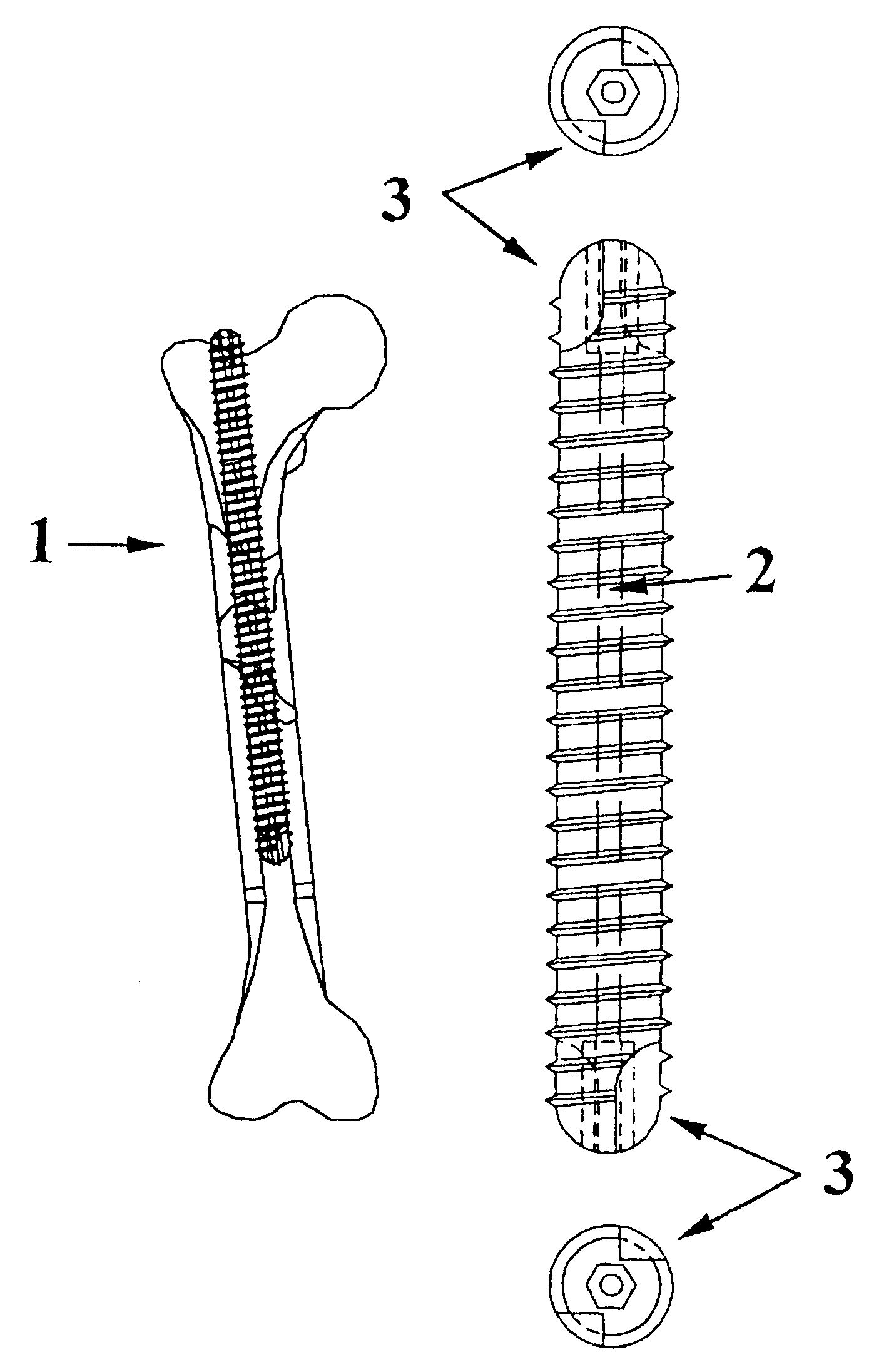 Axial intramedullary screw for the osteosynthesis of long bones
