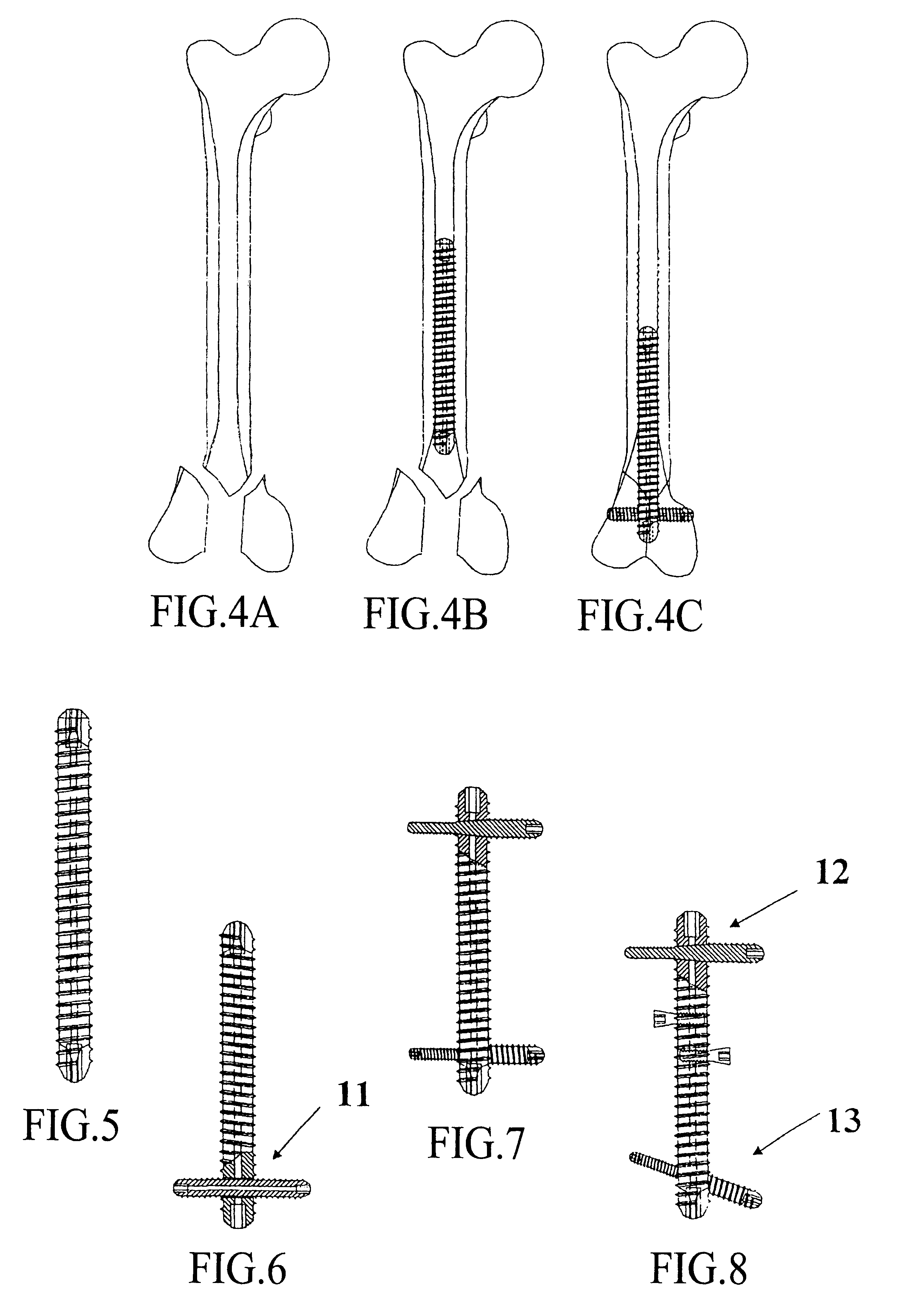 Axial intramedullary screw for the osteosynthesis of long bones