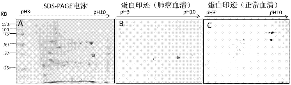 A screening and identification method of ech1 autoantibody and its application