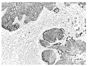 Histological classification immunohistochemical multiple staining detection method for lung cancer