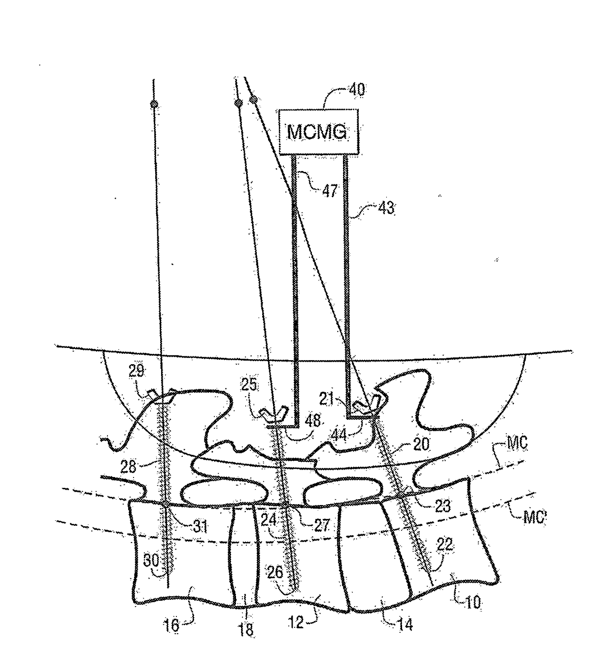 Methods and apparatus for spinal reconstructive surgery and measuring spinal length and intervertebral spacing, tension and rotation
