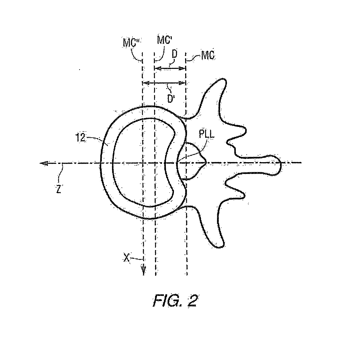 Methods and apparatus for spinal reconstructive surgery and measuring spinal length and intervertebral spacing, tension and rotation