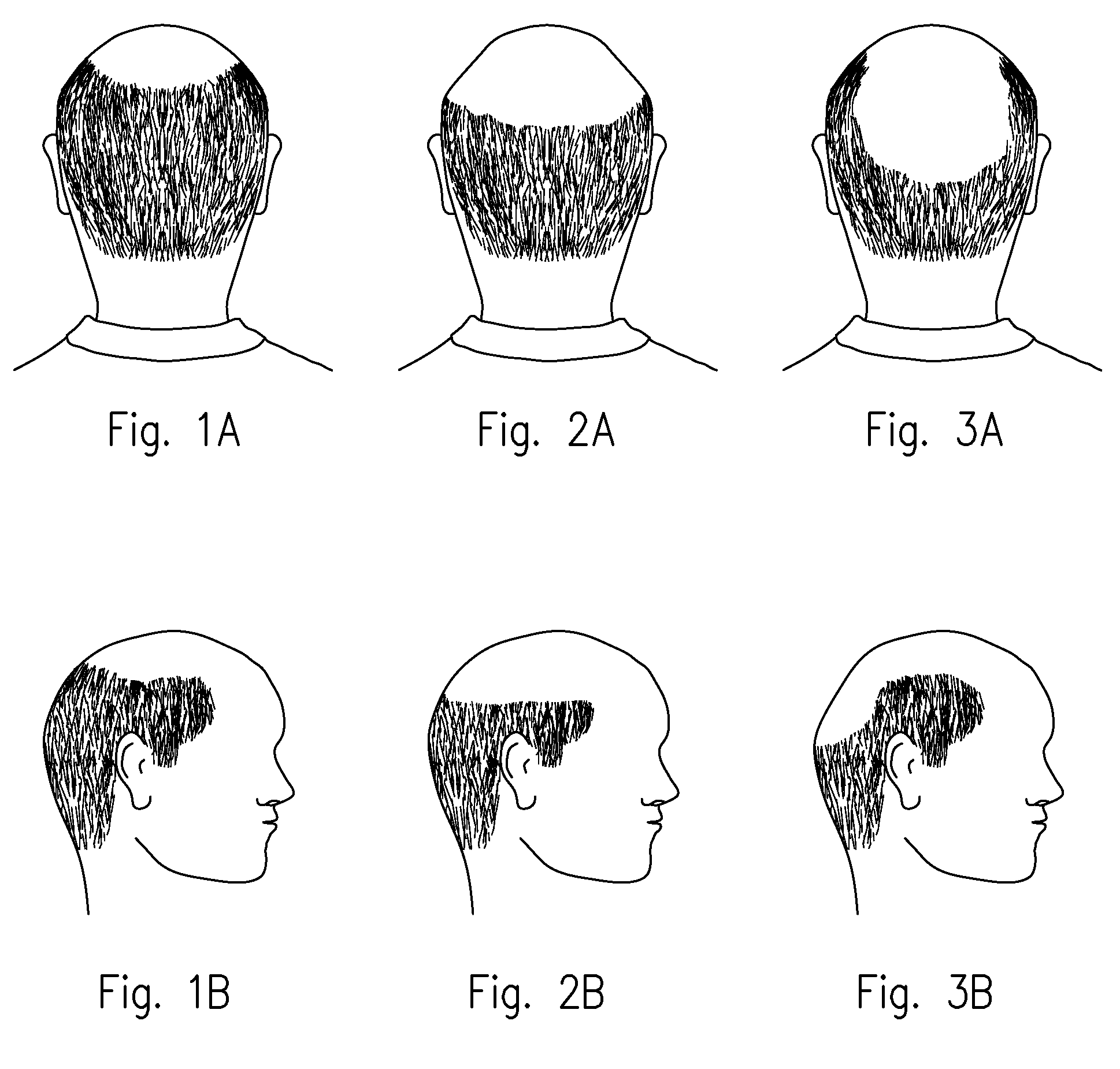 Method with apparatus to prevent baldness and stimulate hair growth