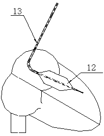 Transthoracic bicuspid valve balloon dilatation catheter assembly and technology thereof