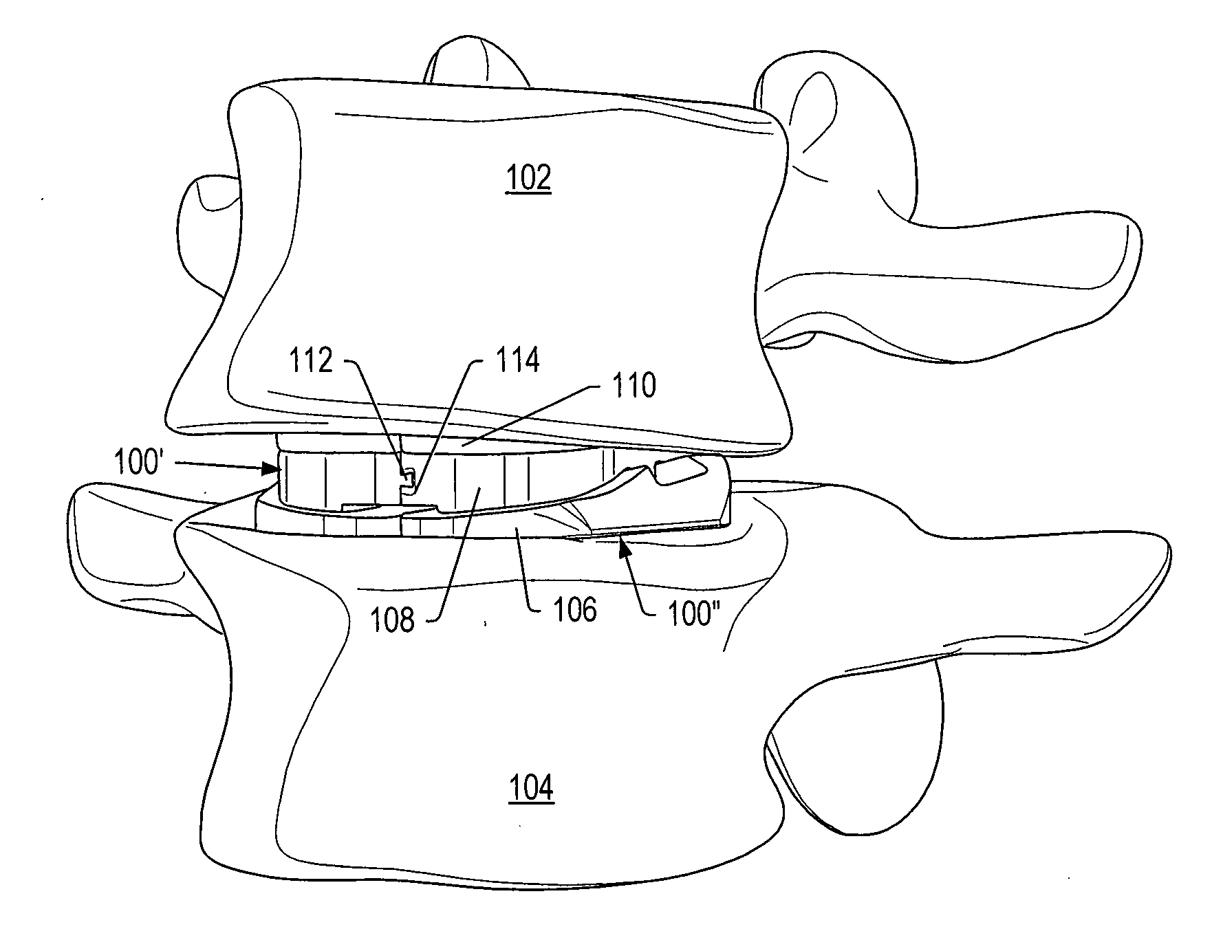 Posterior stabilization system with isolated, dual dampener systems