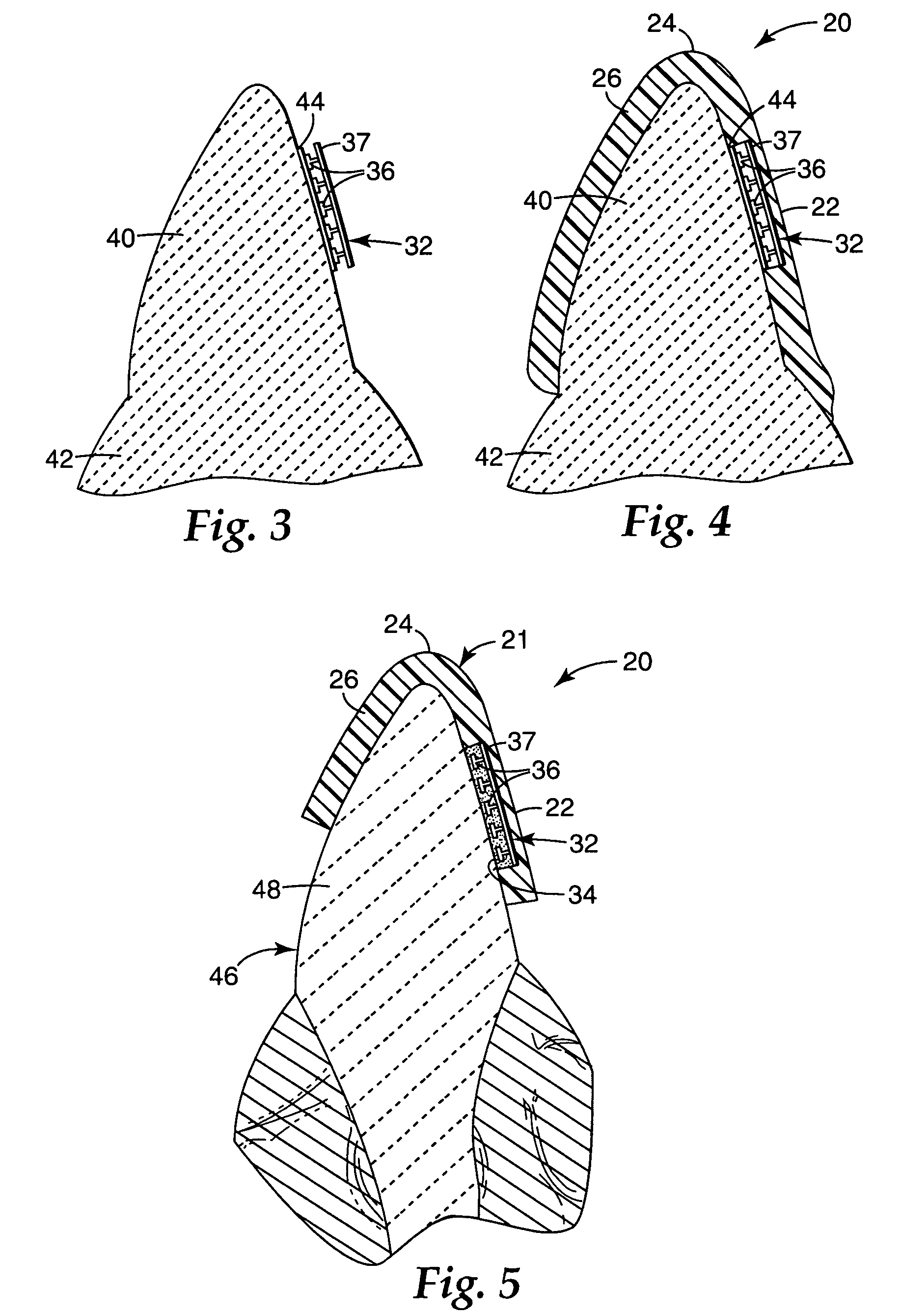 Orthodontic methods and apparatus for applying a composition to a patient's teeth