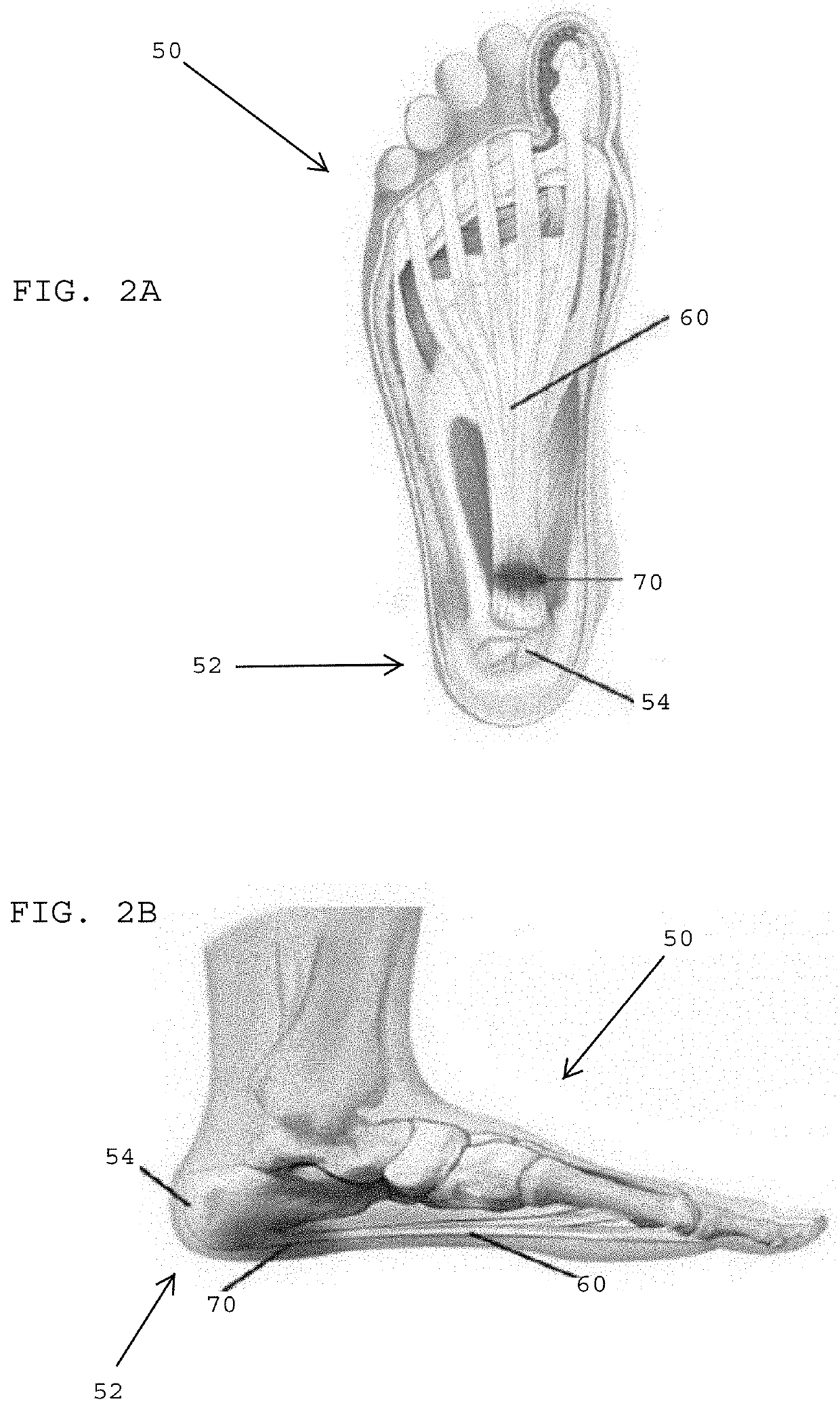 Systems, devices, and non-invasive surgical methods for treating plantar fasciitis and chronic heel spur syndrome