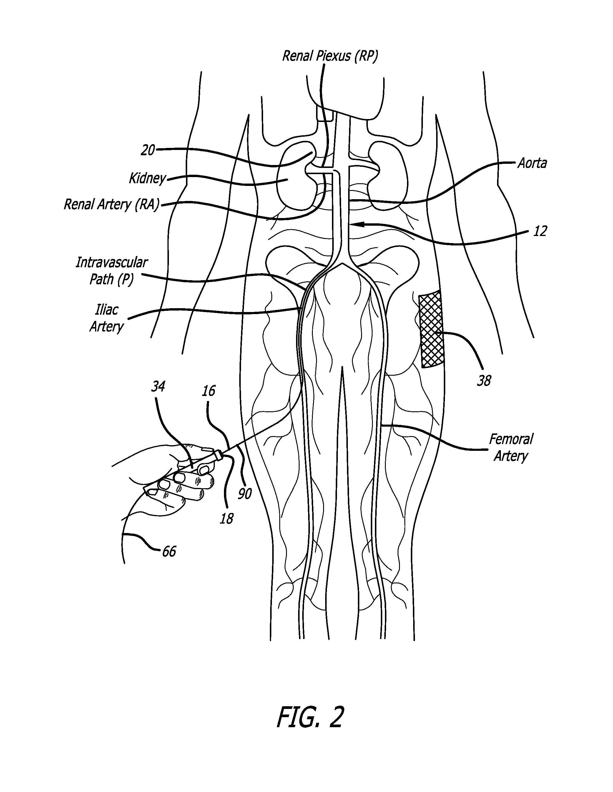 System and method for denervation