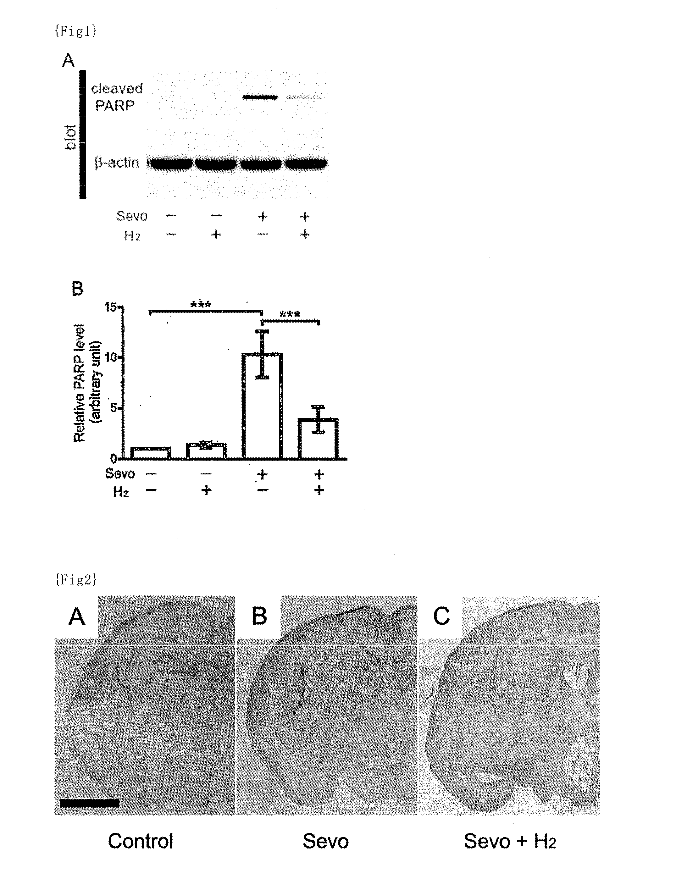 Medicine comprising combination of general anesthetic and hydrogen