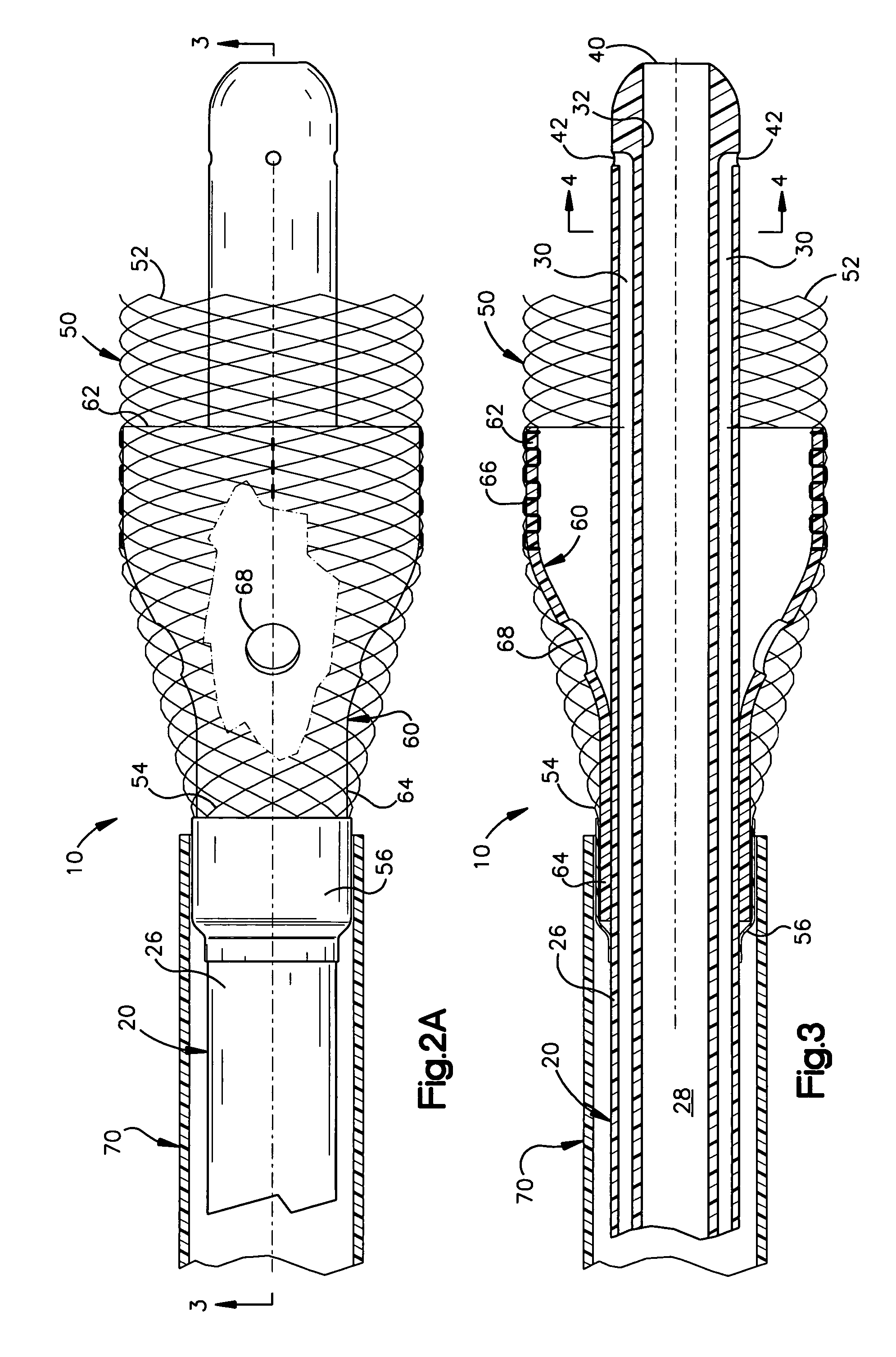 Apparatus for auto-retroperfusion of a coronary vein
