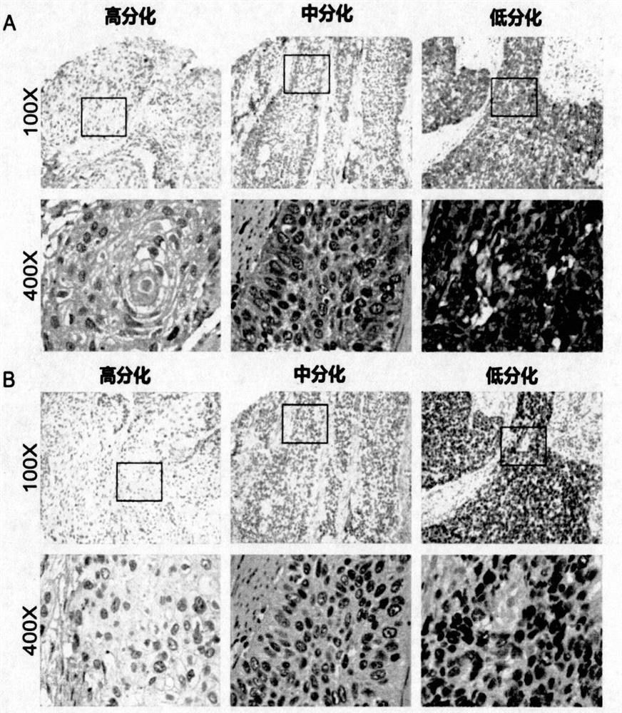 Application of nfi transcription factor in esophageal squamous cell carcinoma