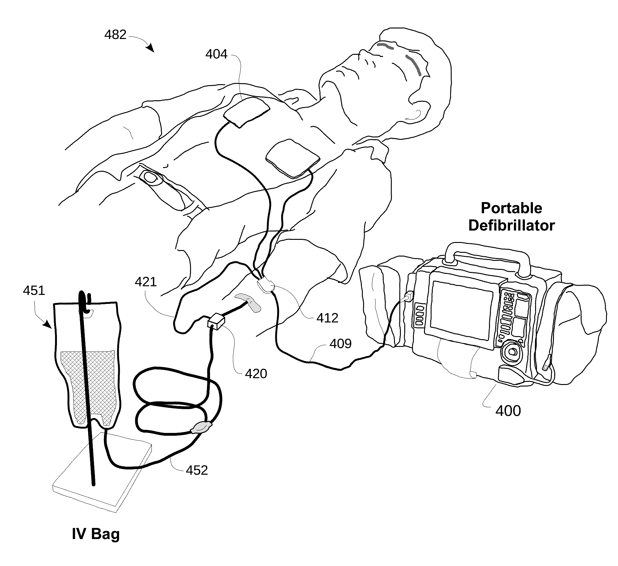 Intravenous line flow sensor for advanced diagnostics and monitoring in emergency medicine