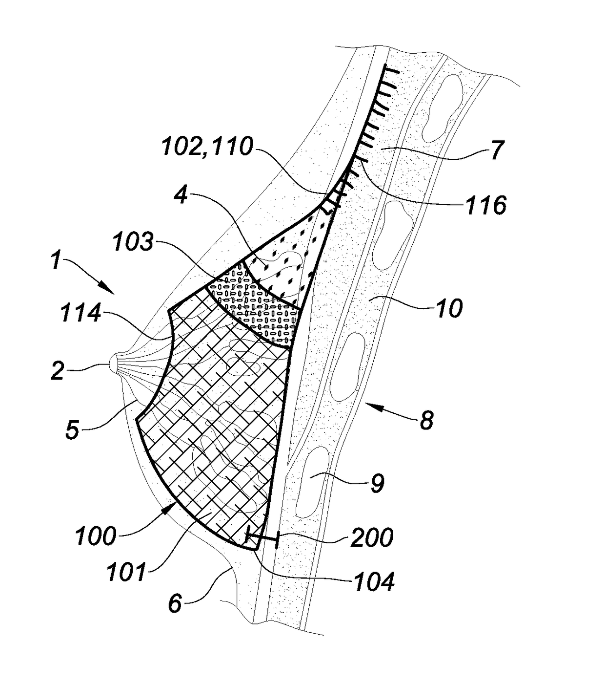 Prosthesis for supporting a breast structure