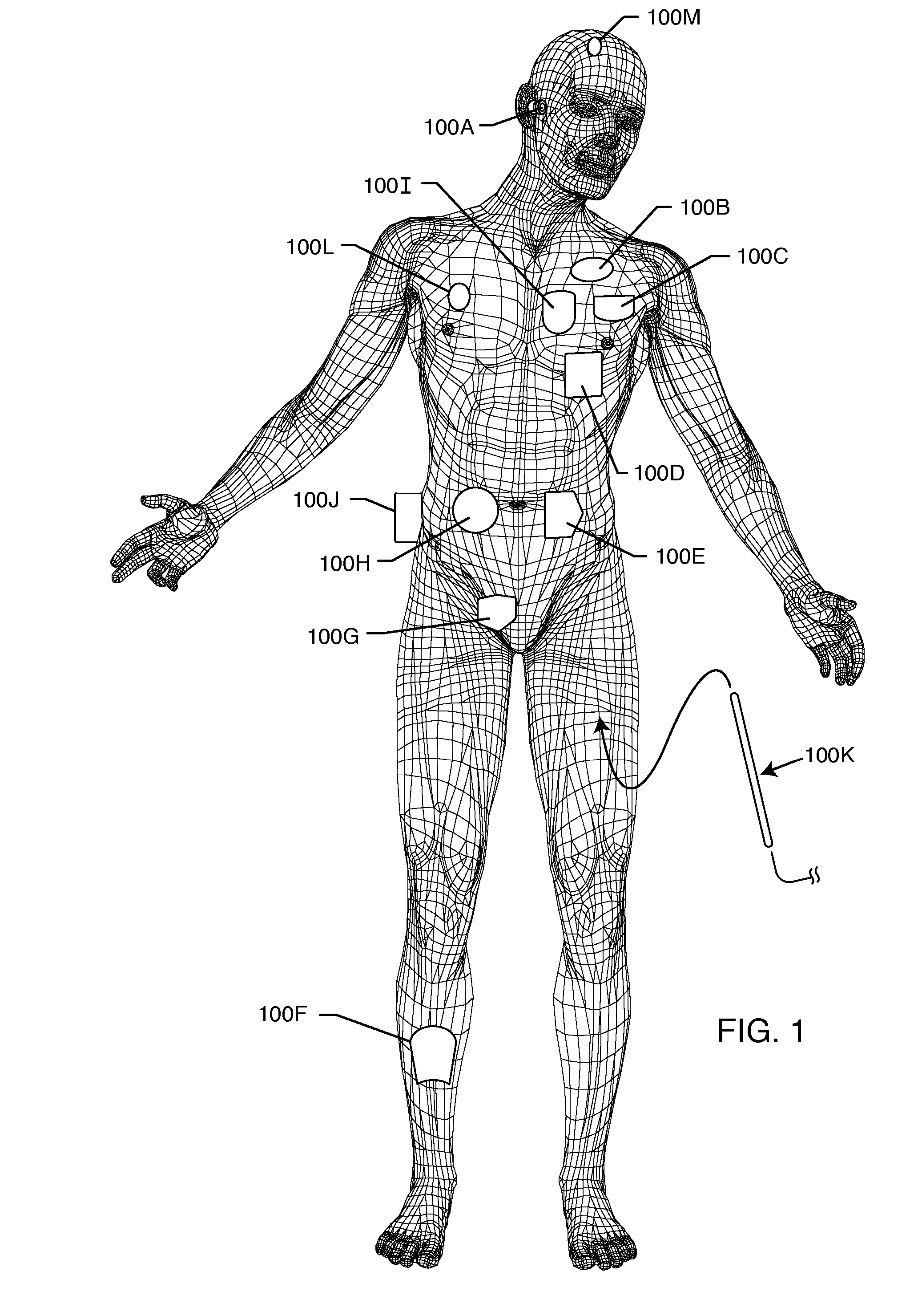 Implantable lead with a band stop filter having a capacitor in parallel with an inductor embedded in a dielectric body
