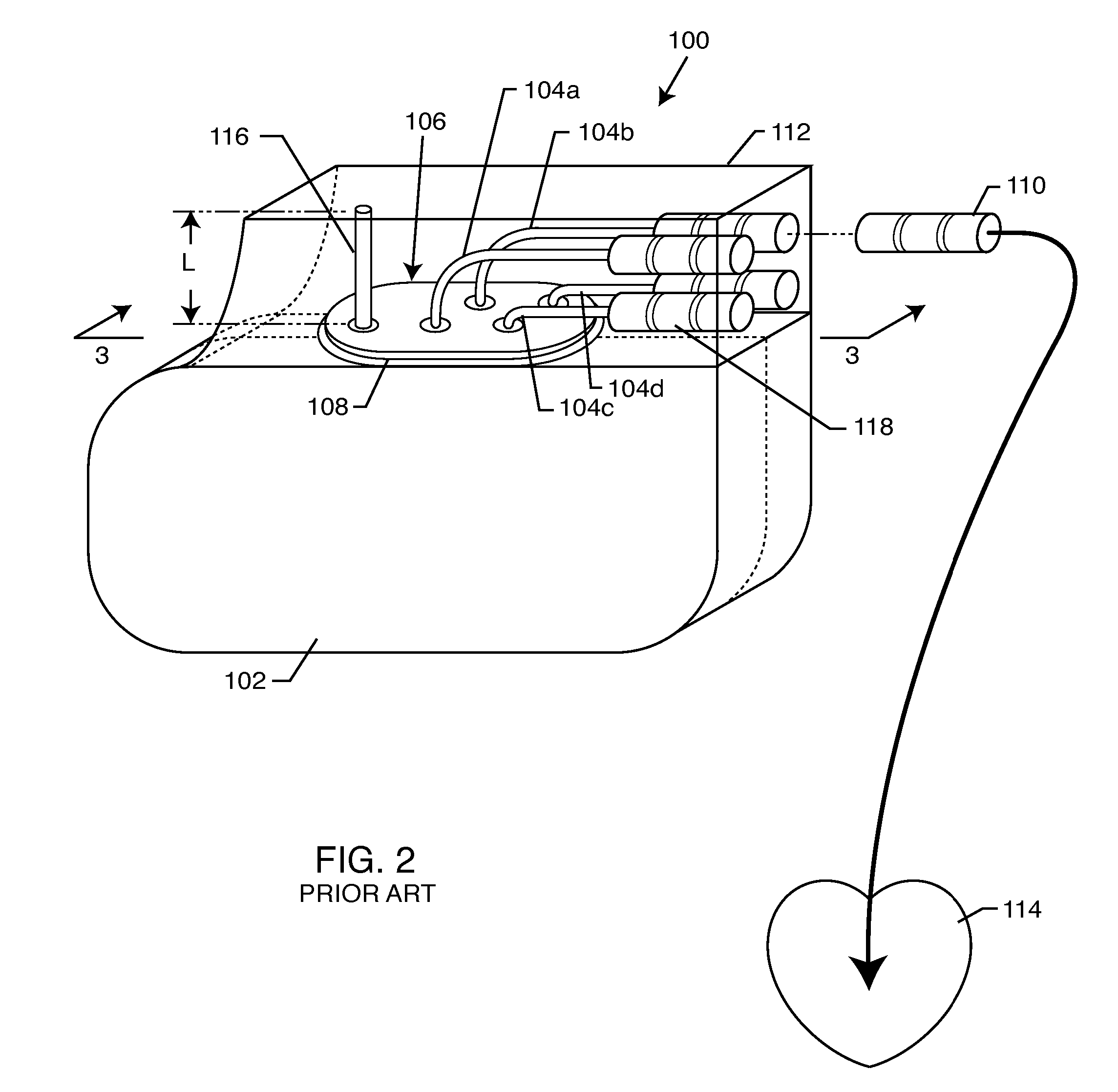 Implantable lead with a band stop filter having a capacitor in parallel with an inductor embedded in a dielectric body