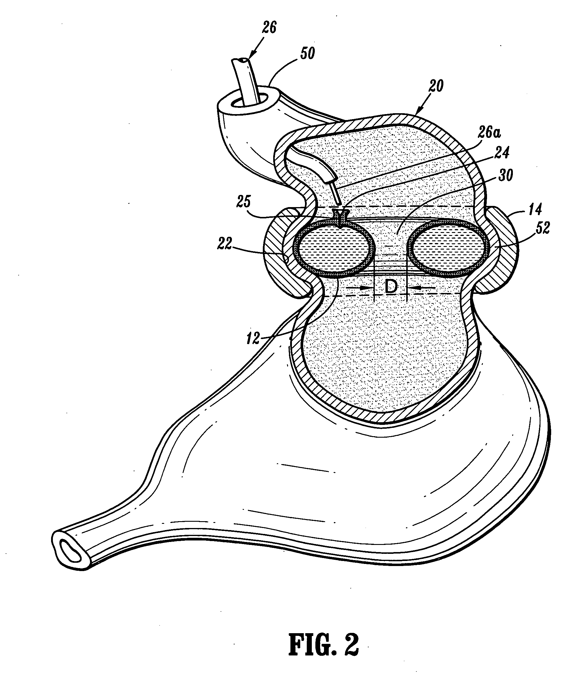 Gastric restrictor assembly and method of use