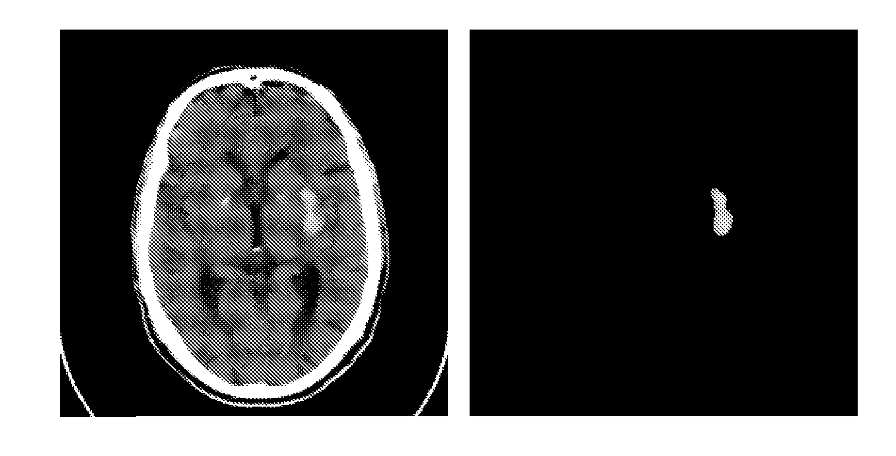 Method and device for detecting bright brain regions from computed tomography images