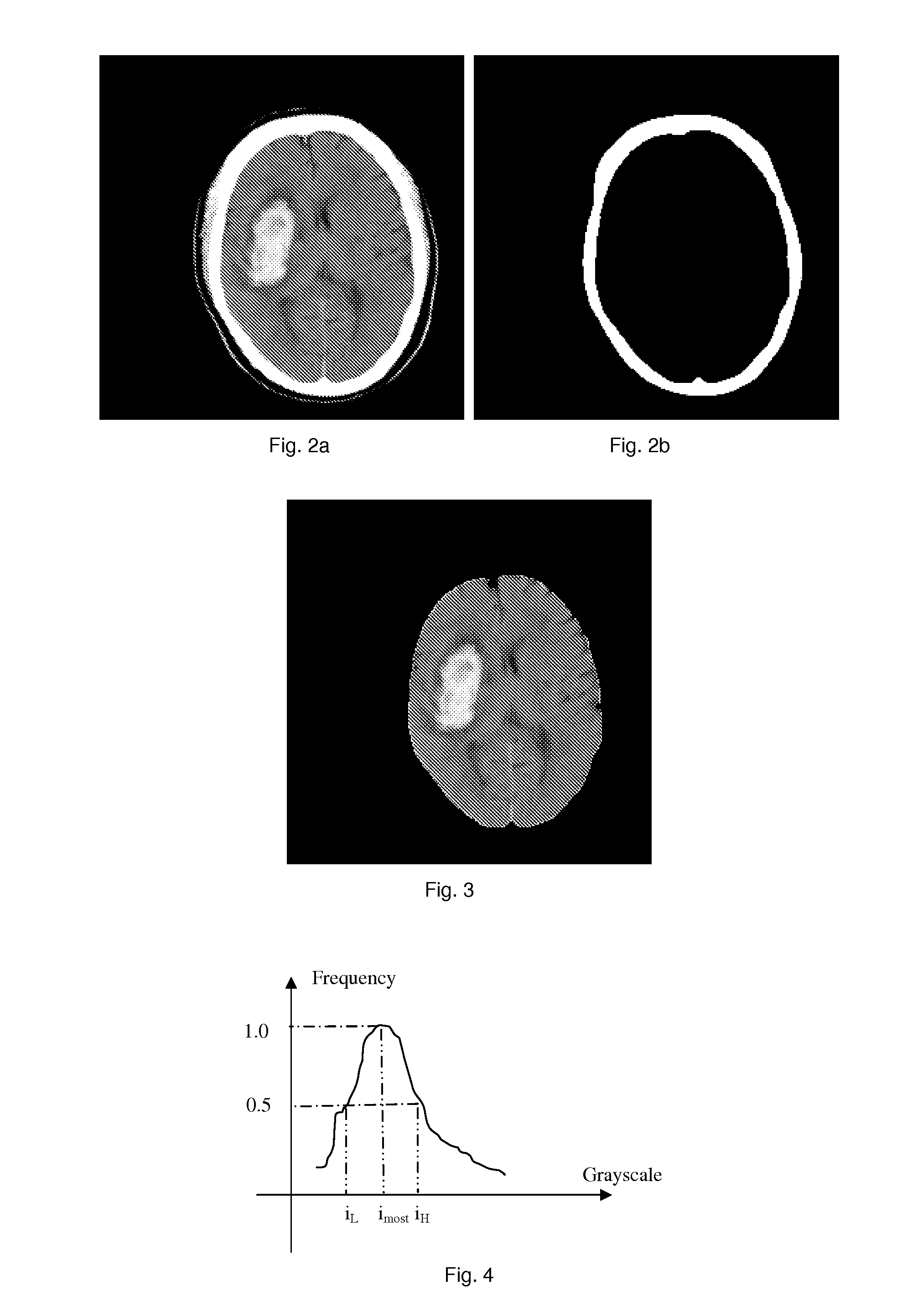 Method and device for detecting bright brain regions from computed tomography images