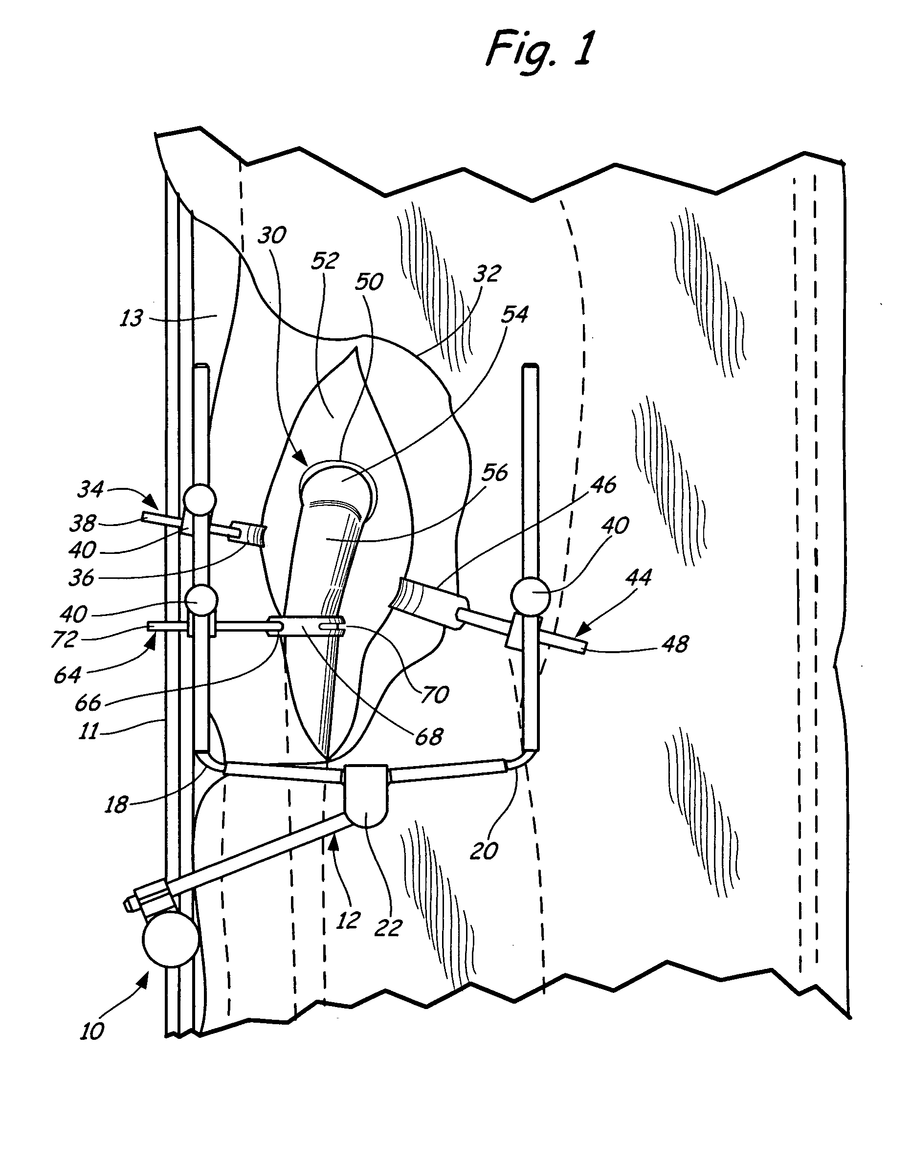 Method of table mounted retraction in hip surgery