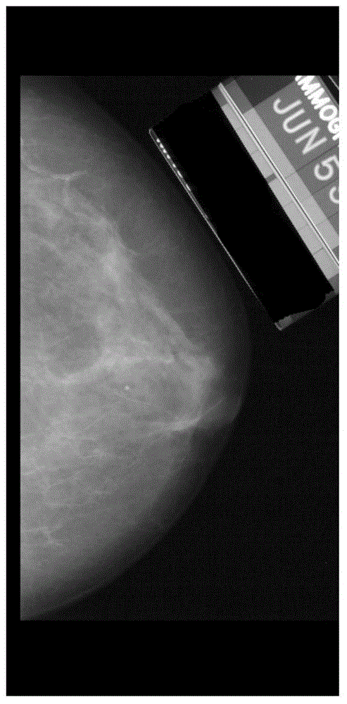 Mammary X-ray image enhancement method