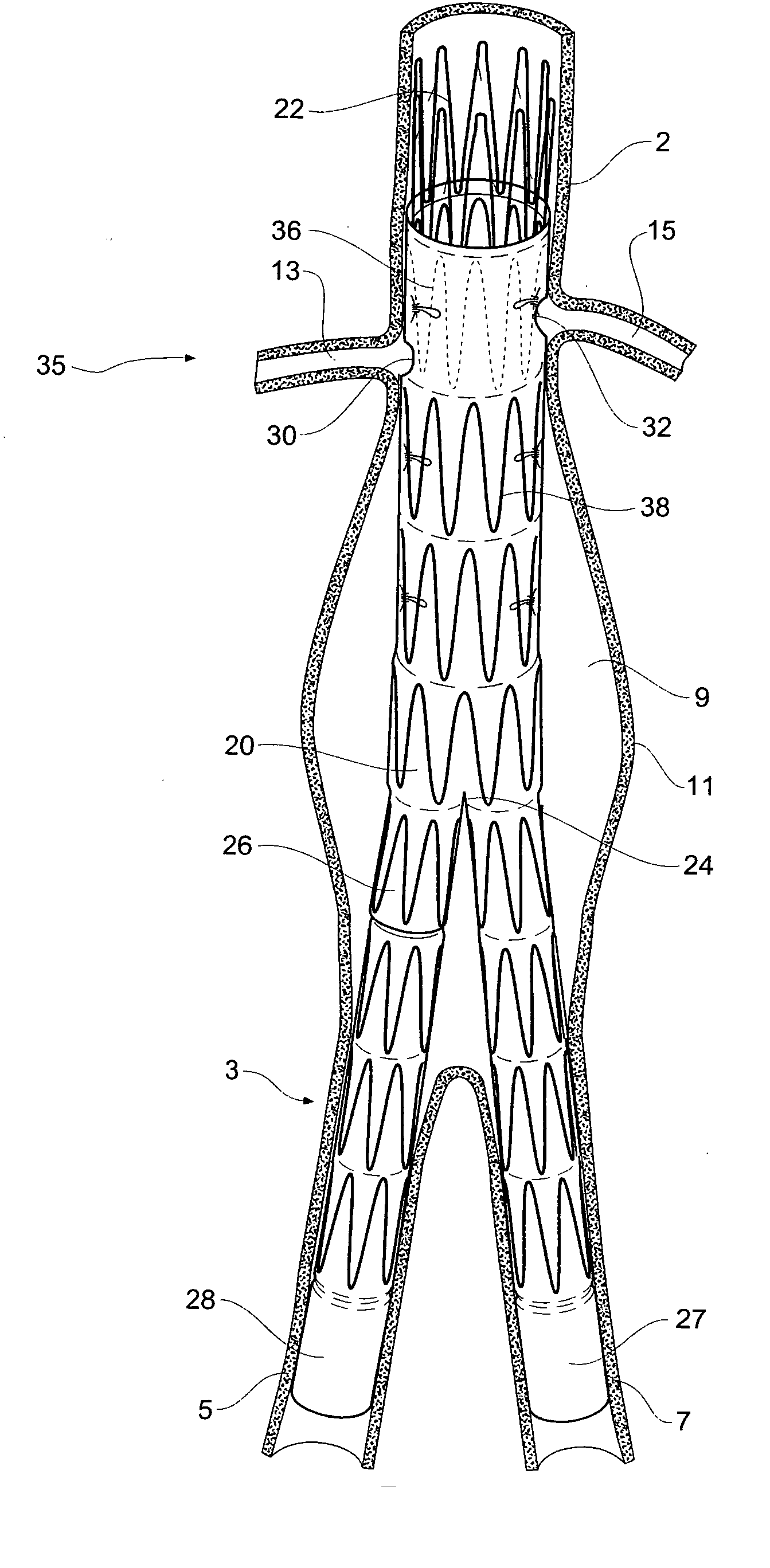 Design and assembly of fenestrated stent grafts
