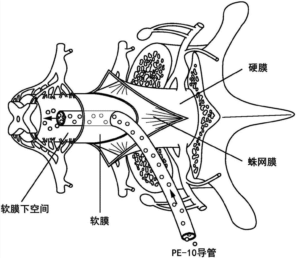 Spinal subpial gene delivery system