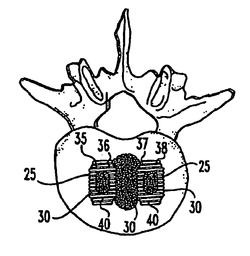 Bone grafts