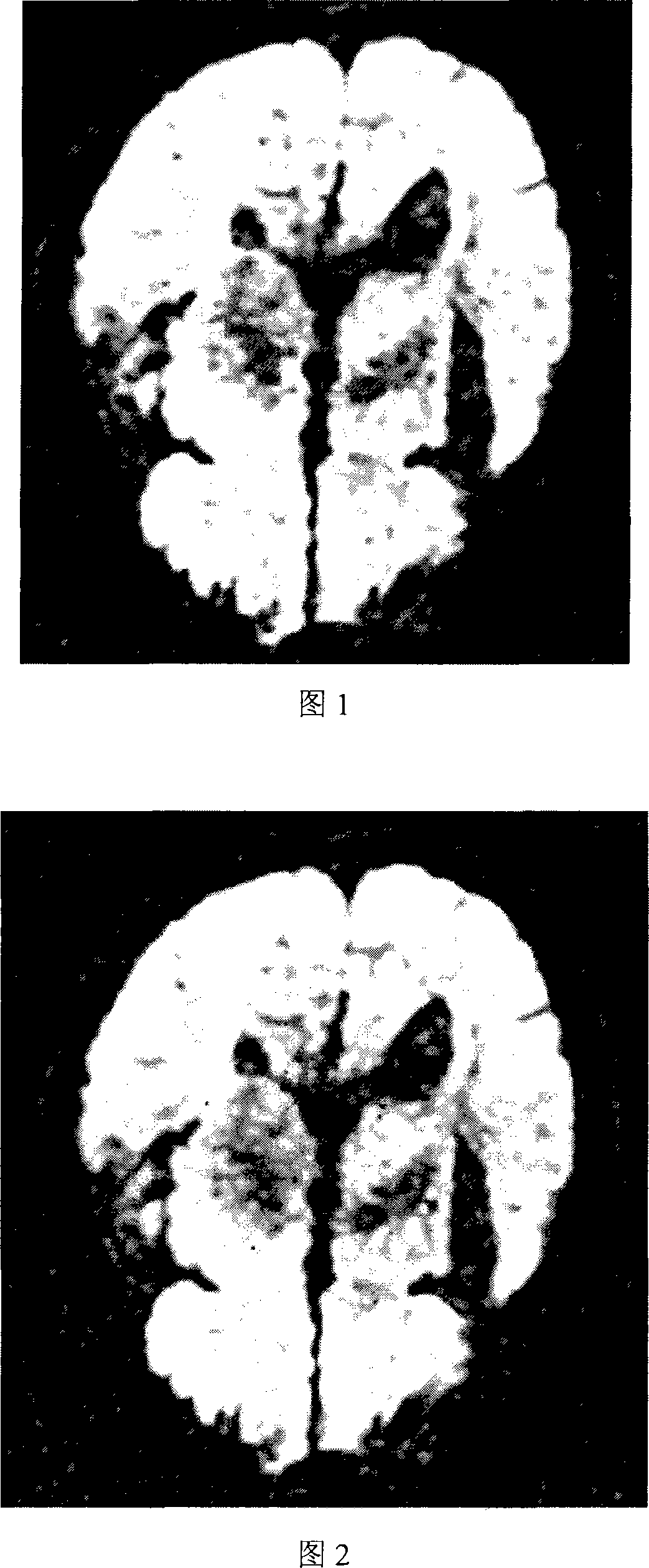 Recovery processing method for diffusion tensor magnetic resonance image
